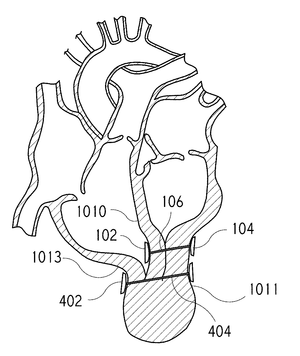 Percutaneous arterial access to position trans-myocardial implant devices and methods