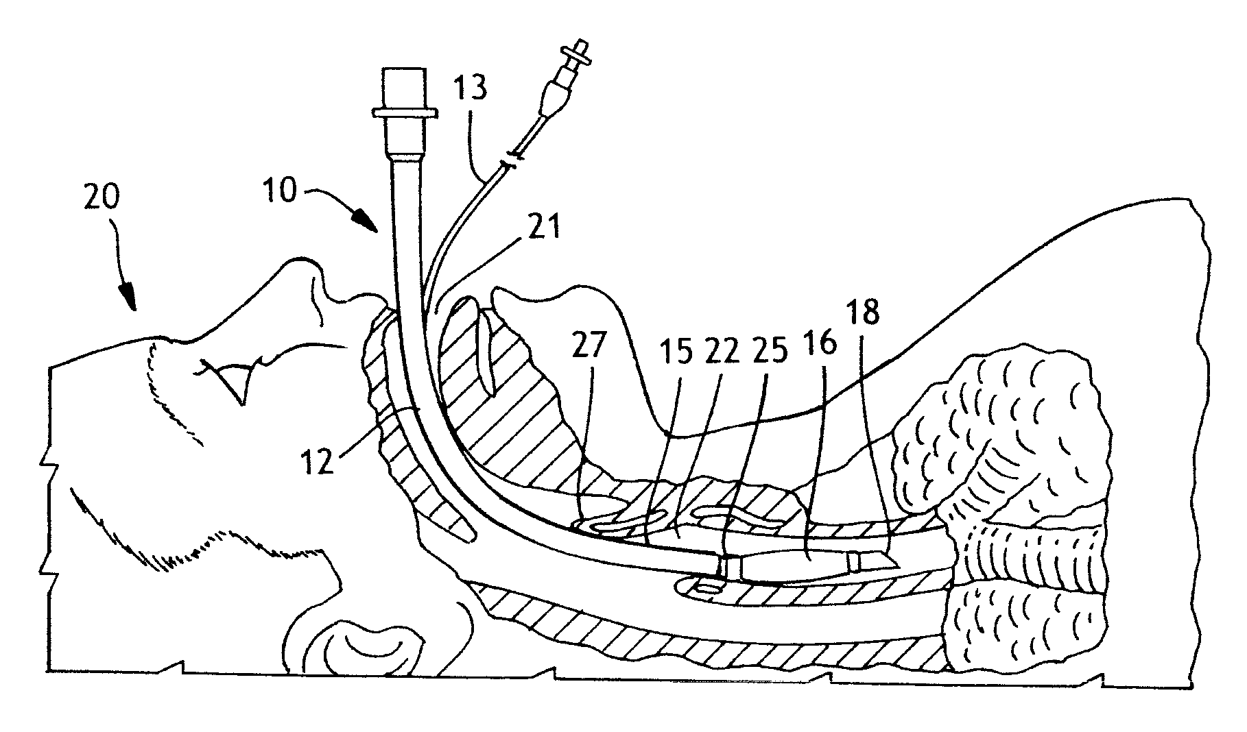Low-pressure airway management device with active coating and method for patient care