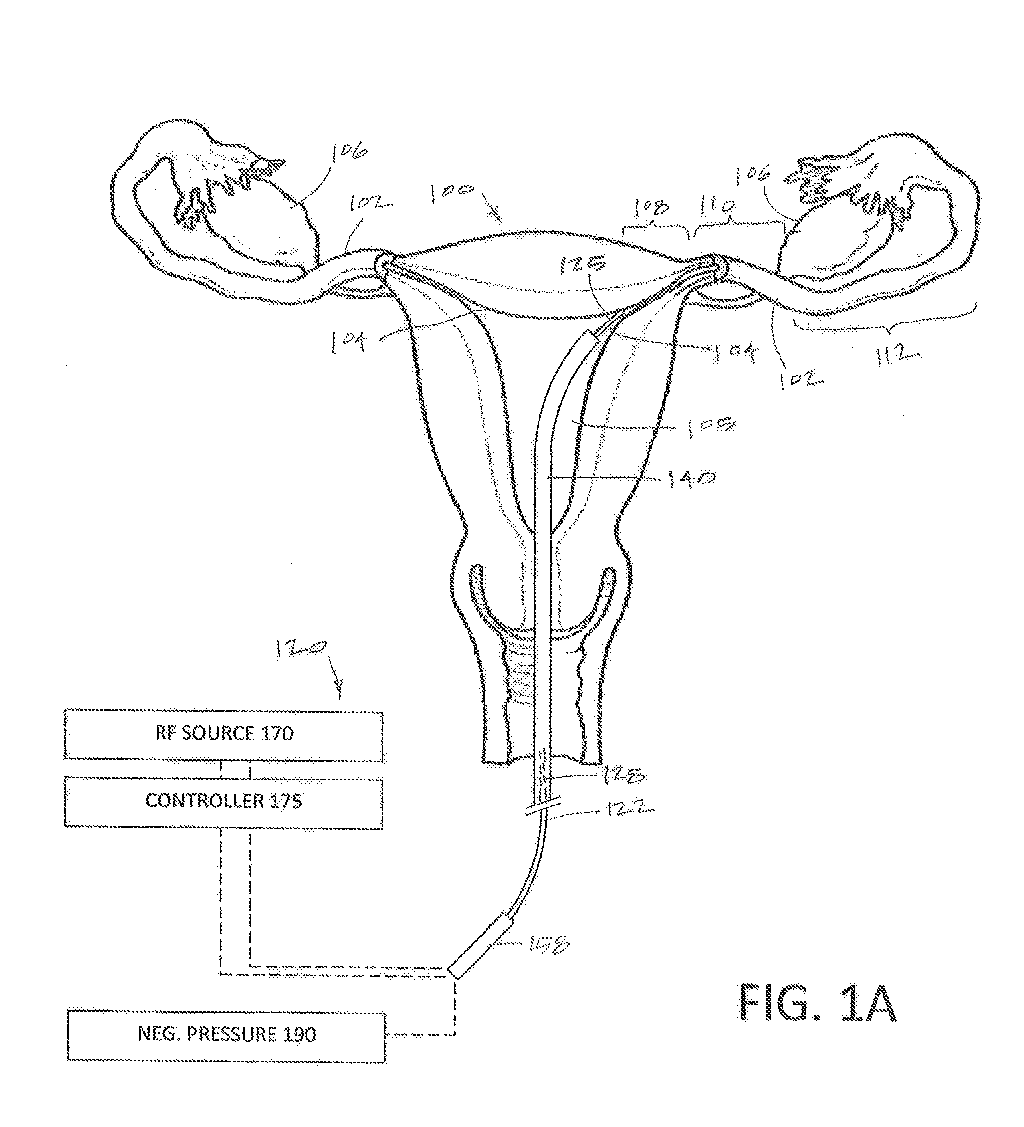 Systems and methods for permanent female contraception