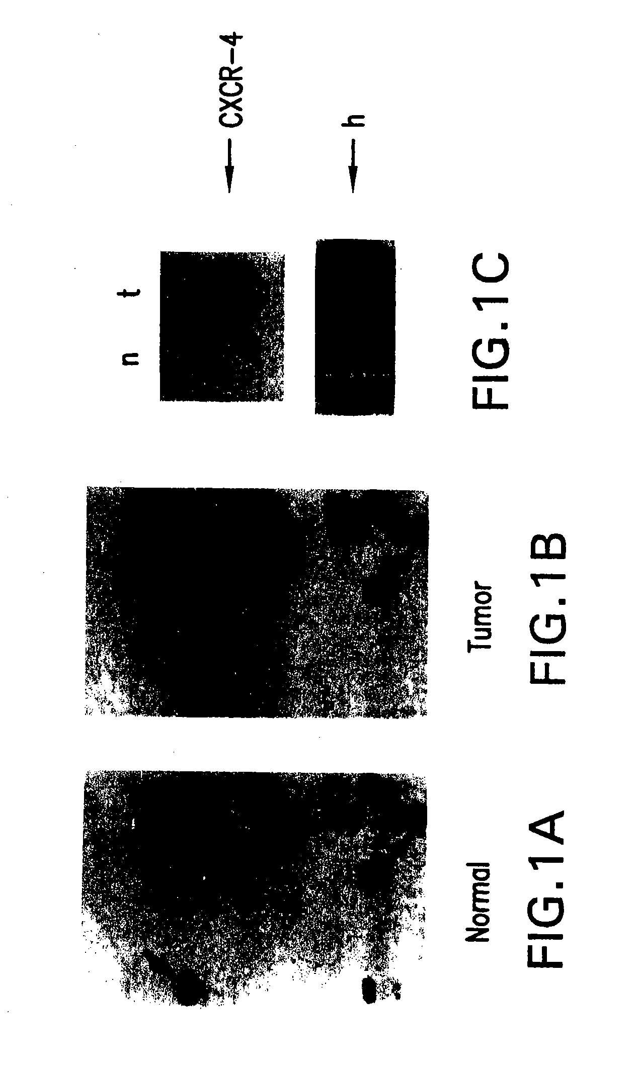 Therapeutic and diagnostic applications based on the role of the cxcr-4 gene in tumorigenesis