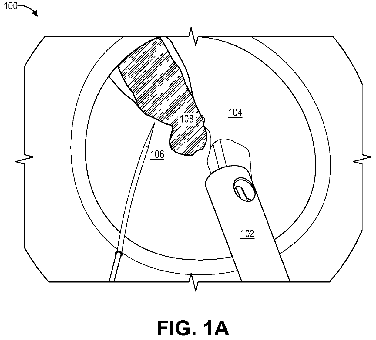 Method for Eye Lens Removal Using Cavitating Microbubbles