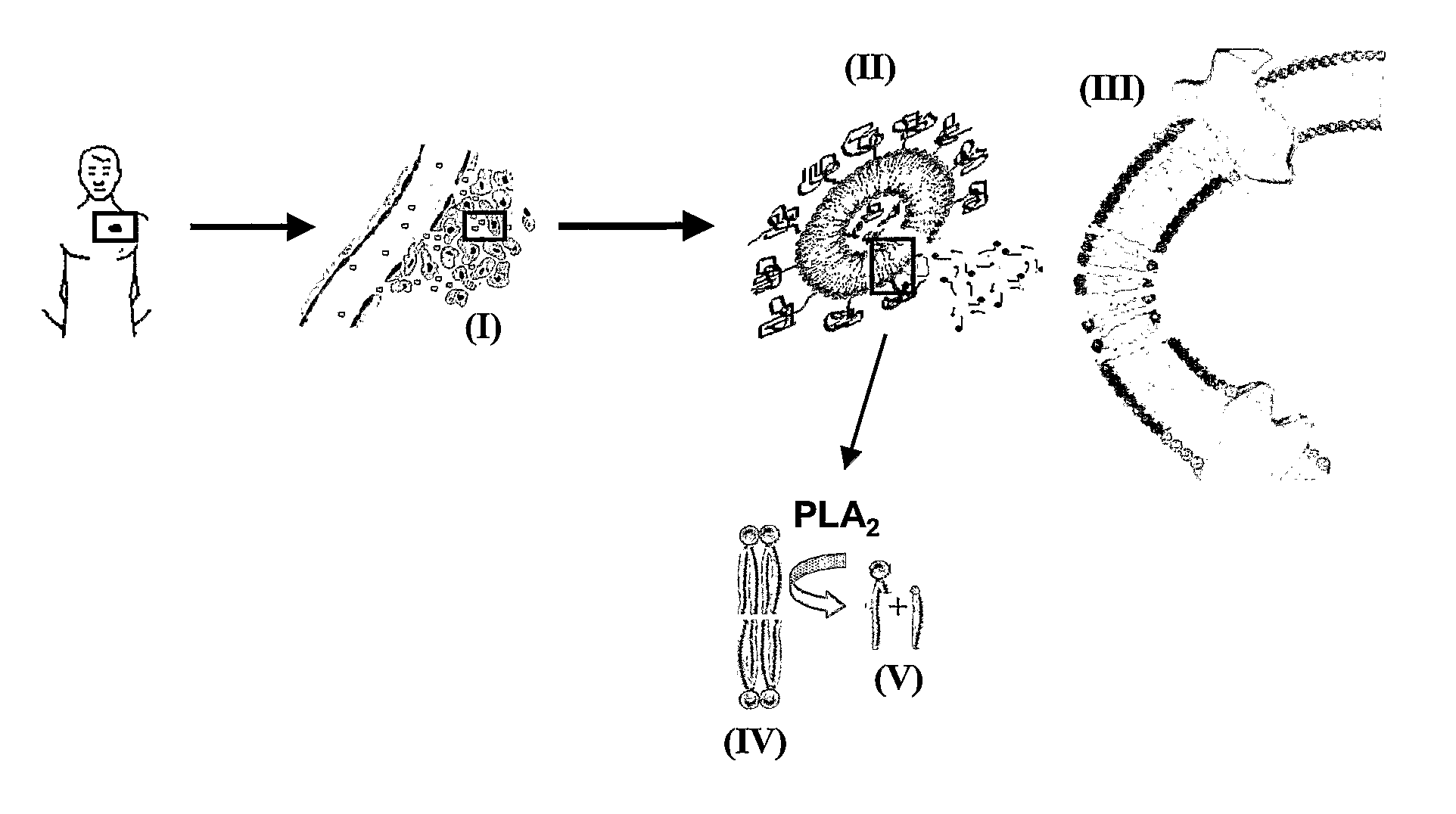 Lipid-Based Drug Delivery Systems Containing Unnatural Phospholipase A2 Degradable Lipid Derivatives and the Therapeutic Uses Thereof