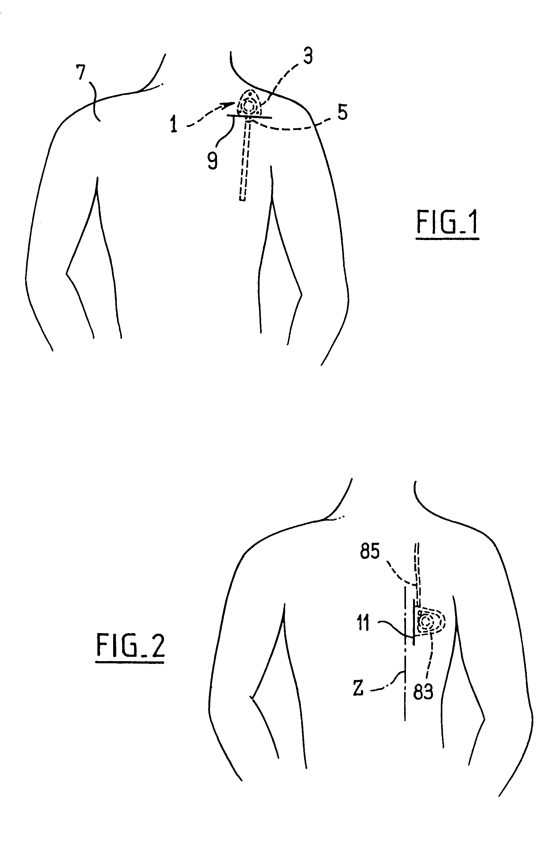 Subcutaneously implantable access port