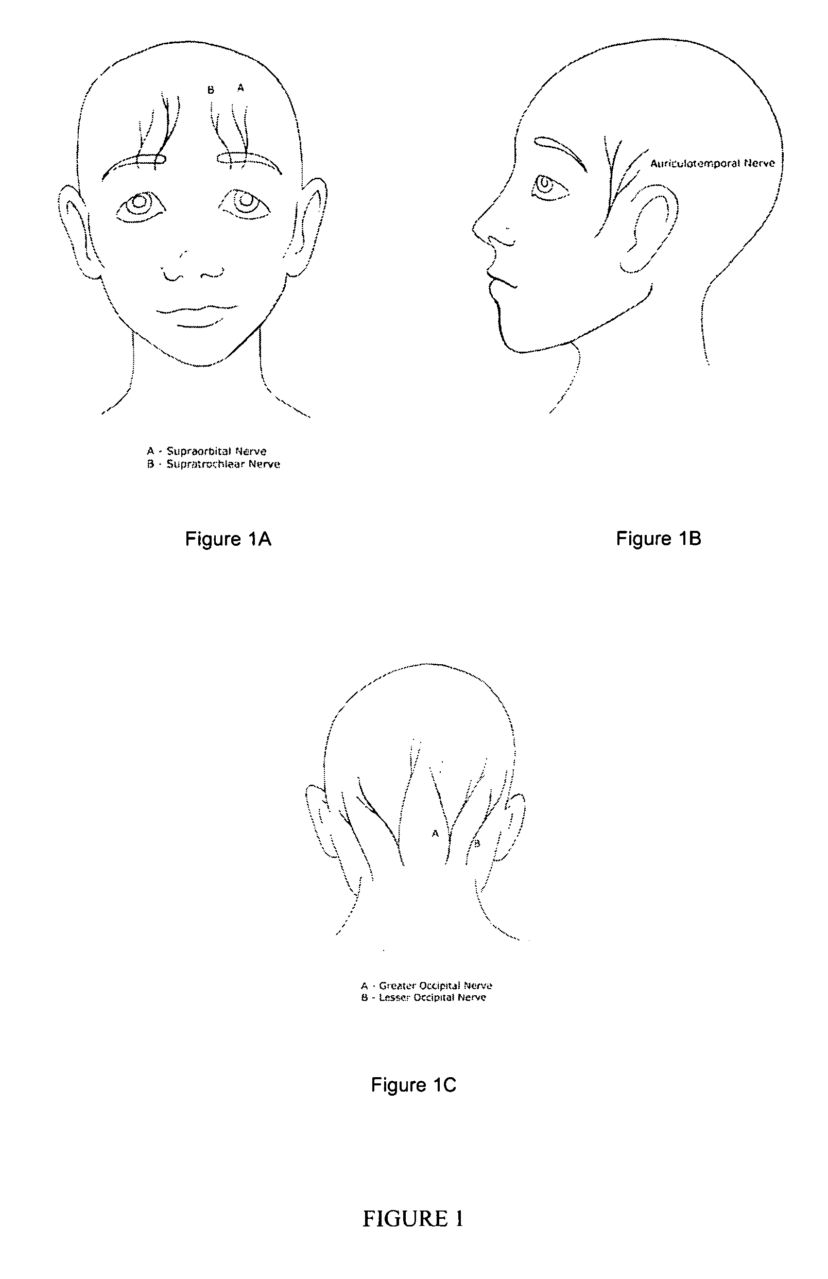 Method and product for headache relief