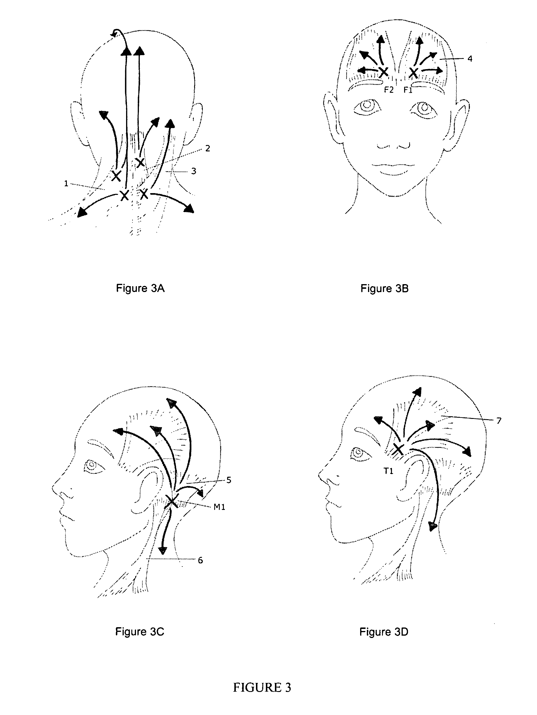 Method and product for headache relief