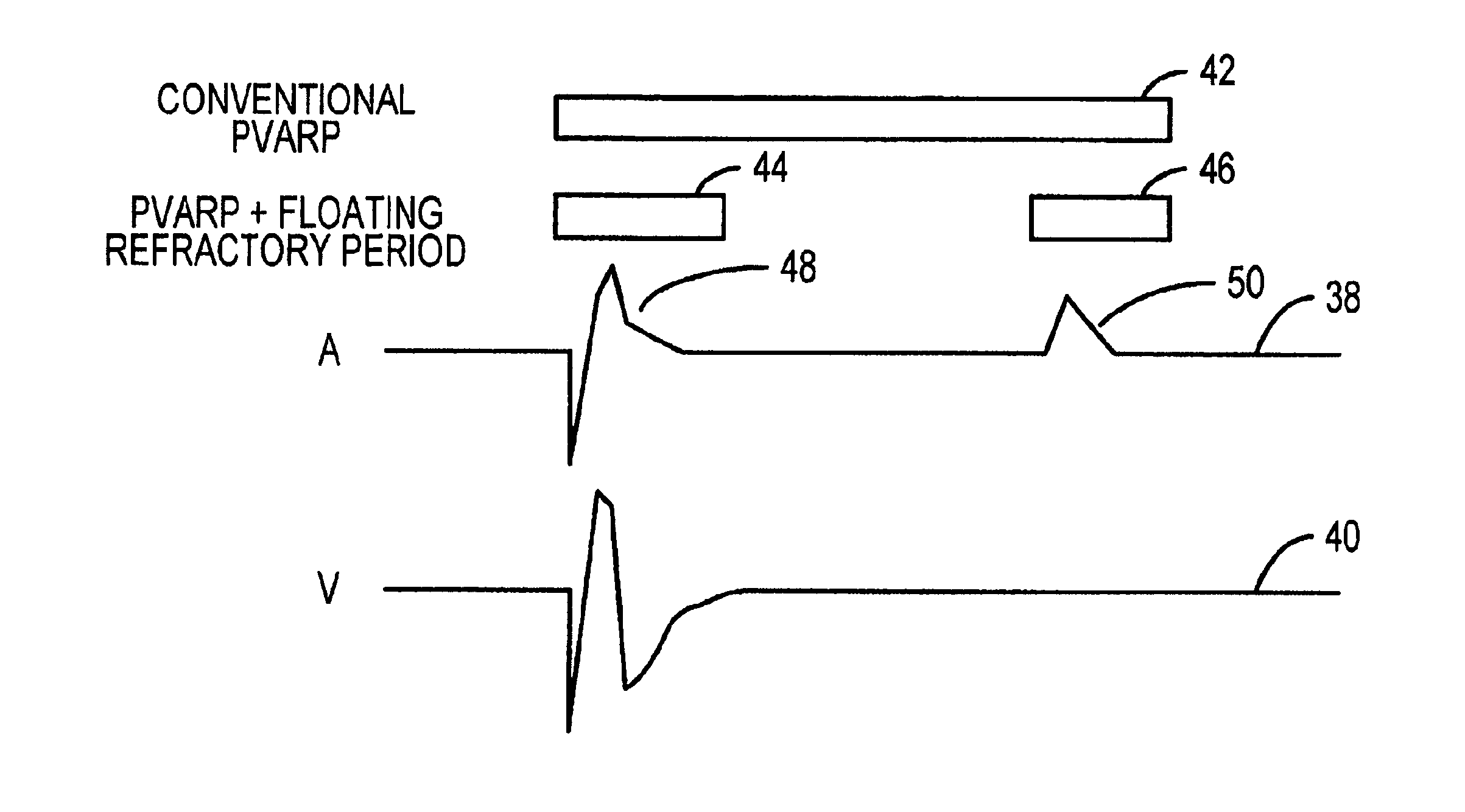 Method and apparatus for avoiding unwanted sensing in a cardiac rhythm management device