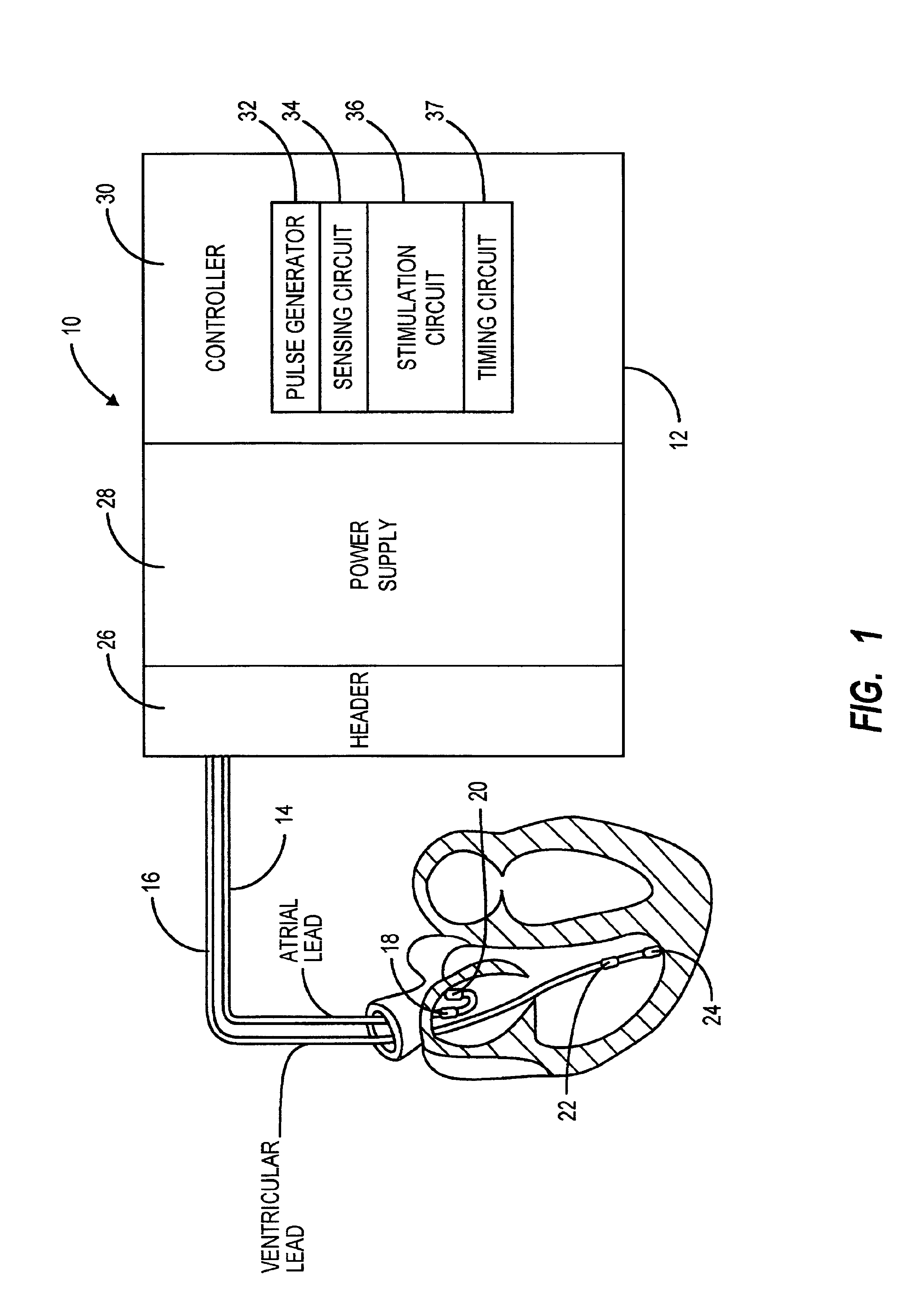 Method and apparatus for avoiding unwanted sensing in a cardiac rhythm management device