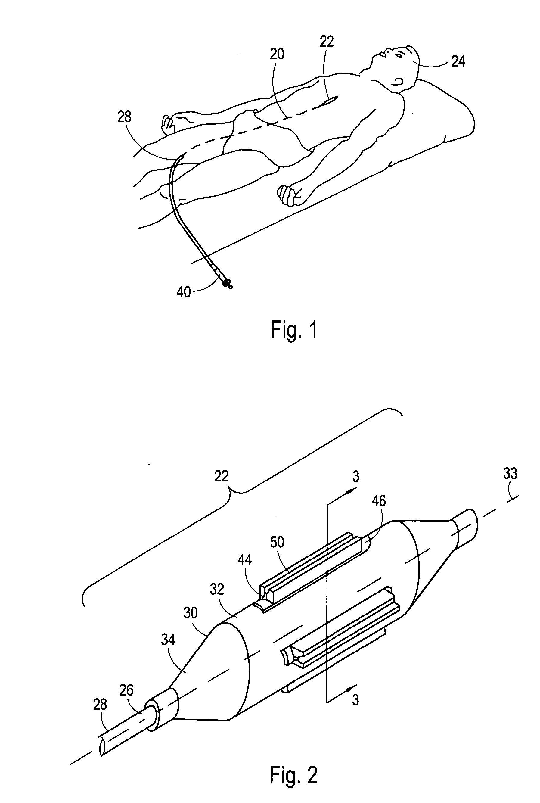 Cutting balloon having sheathed incising elements