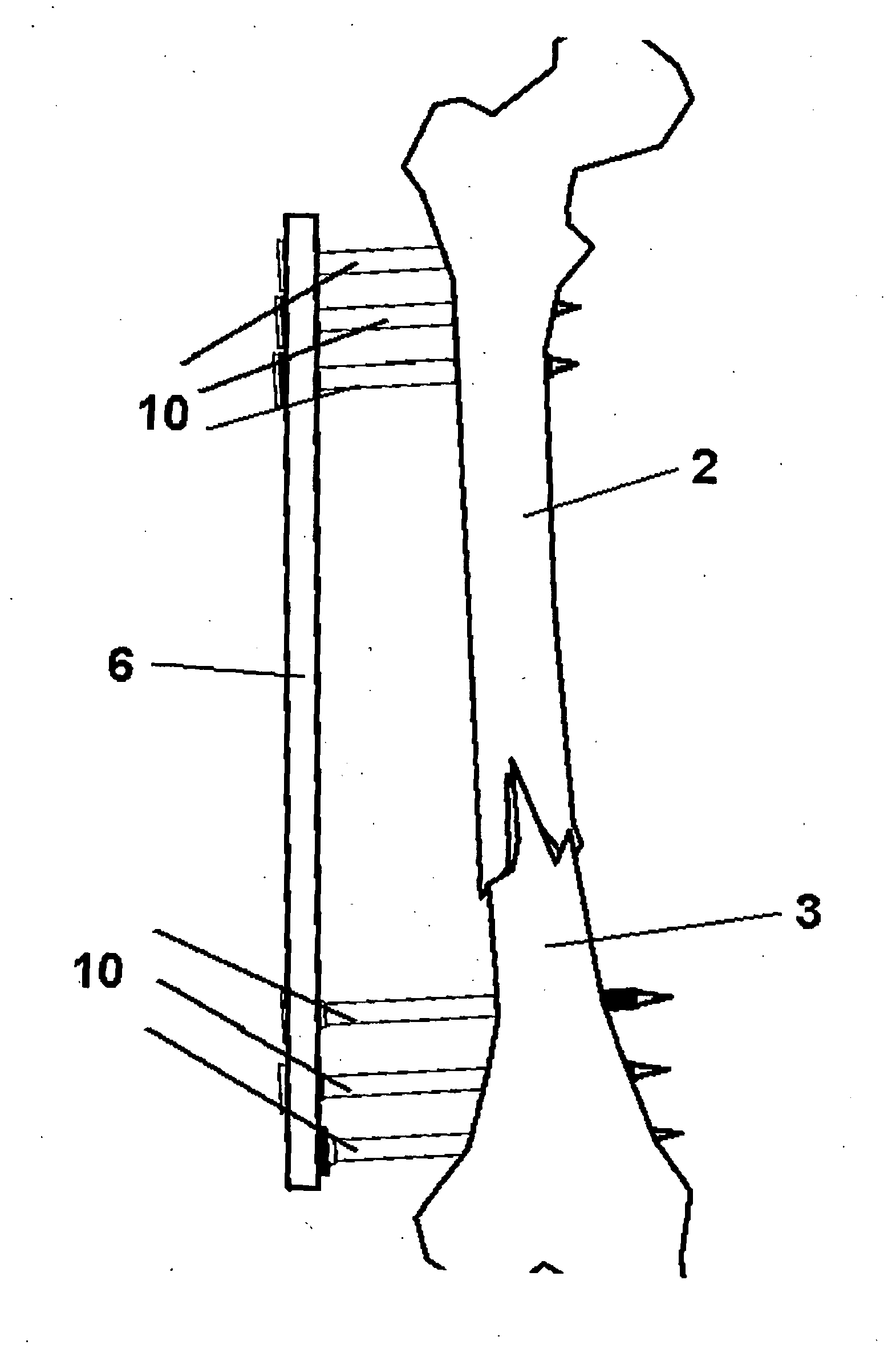 Method and Apparatus for Minimally Invasive Subcutaneous Treatment of Long Bone Fractures