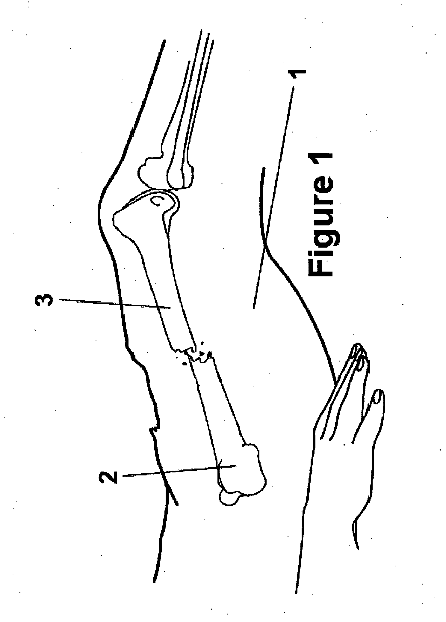 Method and Apparatus for Minimally Invasive Subcutaneous Treatment of Long Bone Fractures