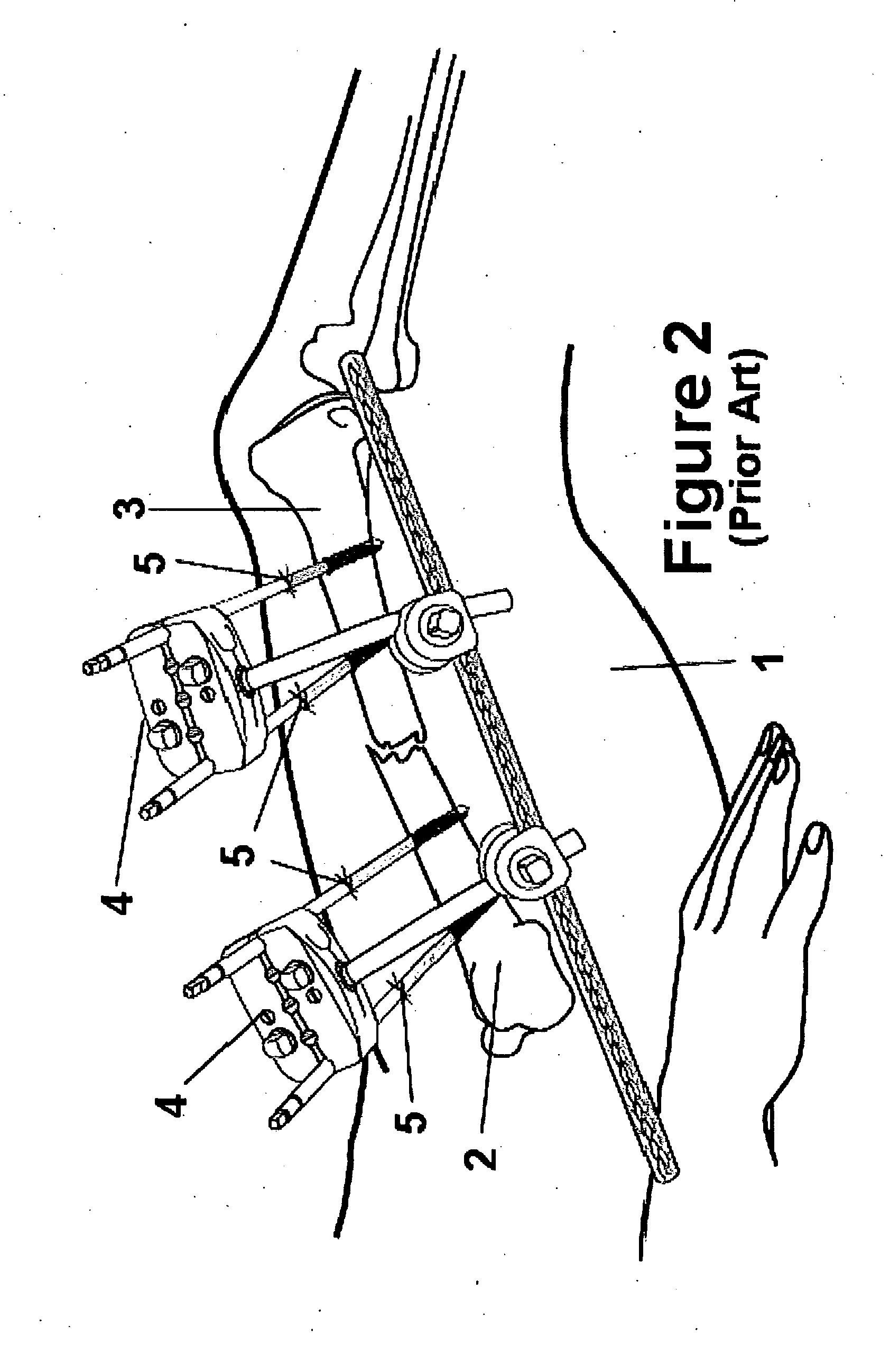 Method and Apparatus for Minimally Invasive Subcutaneous Treatment of Long Bone Fractures