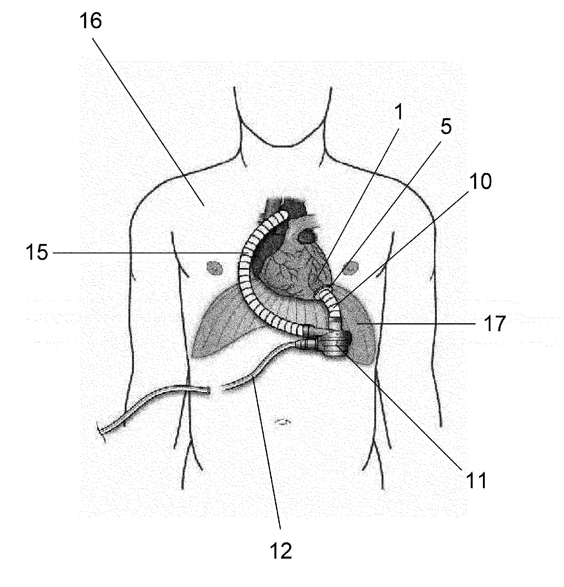 Medical device or instrument having porous structure