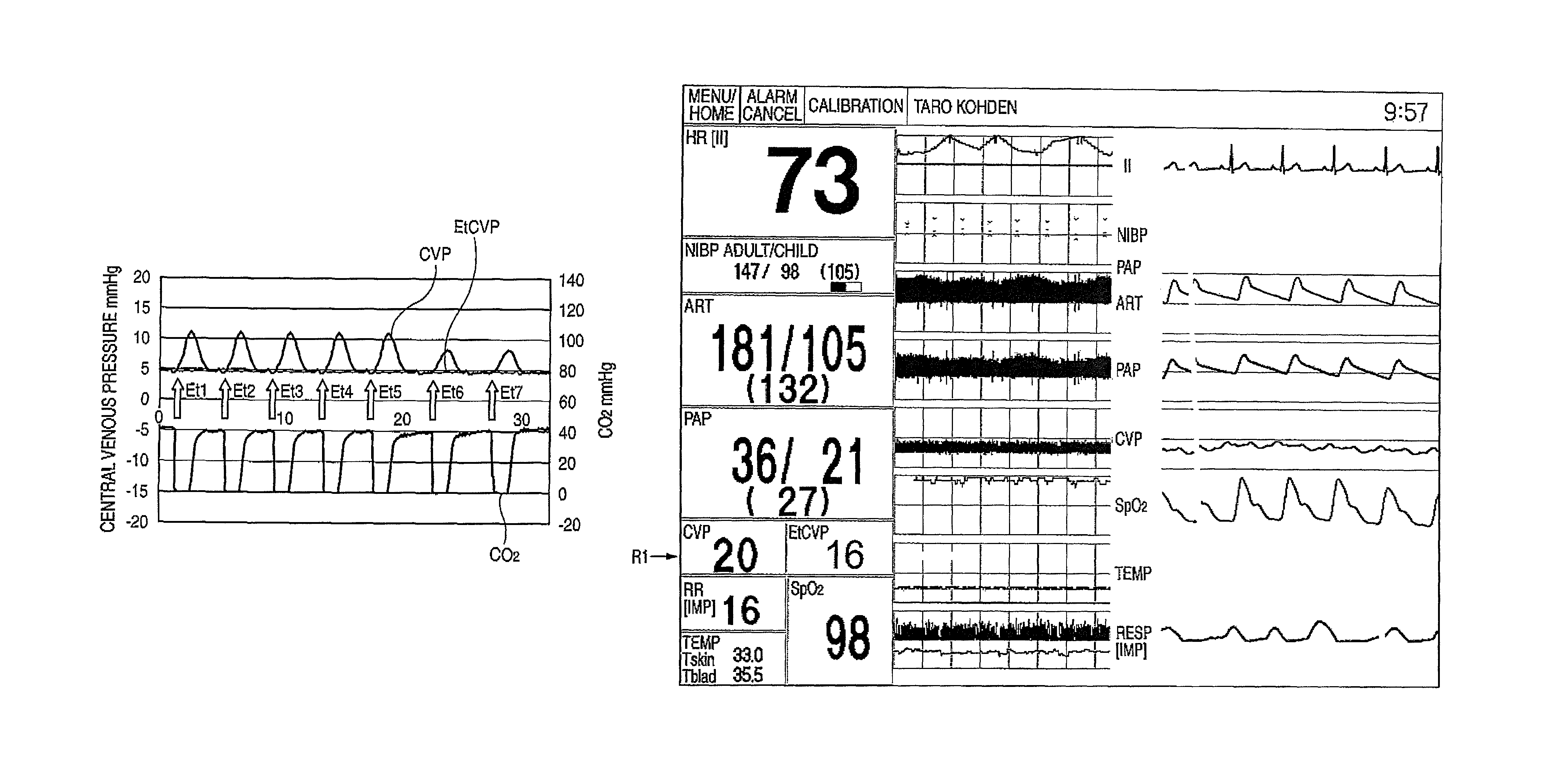 Apparatus for biological signal measurement at point of end-tidal