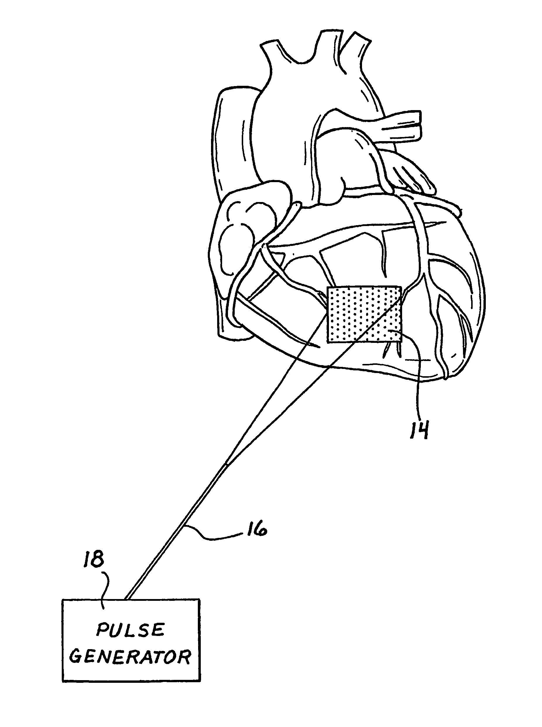 Method and apparatus for using an electromagnetic field in cellular transplantation
