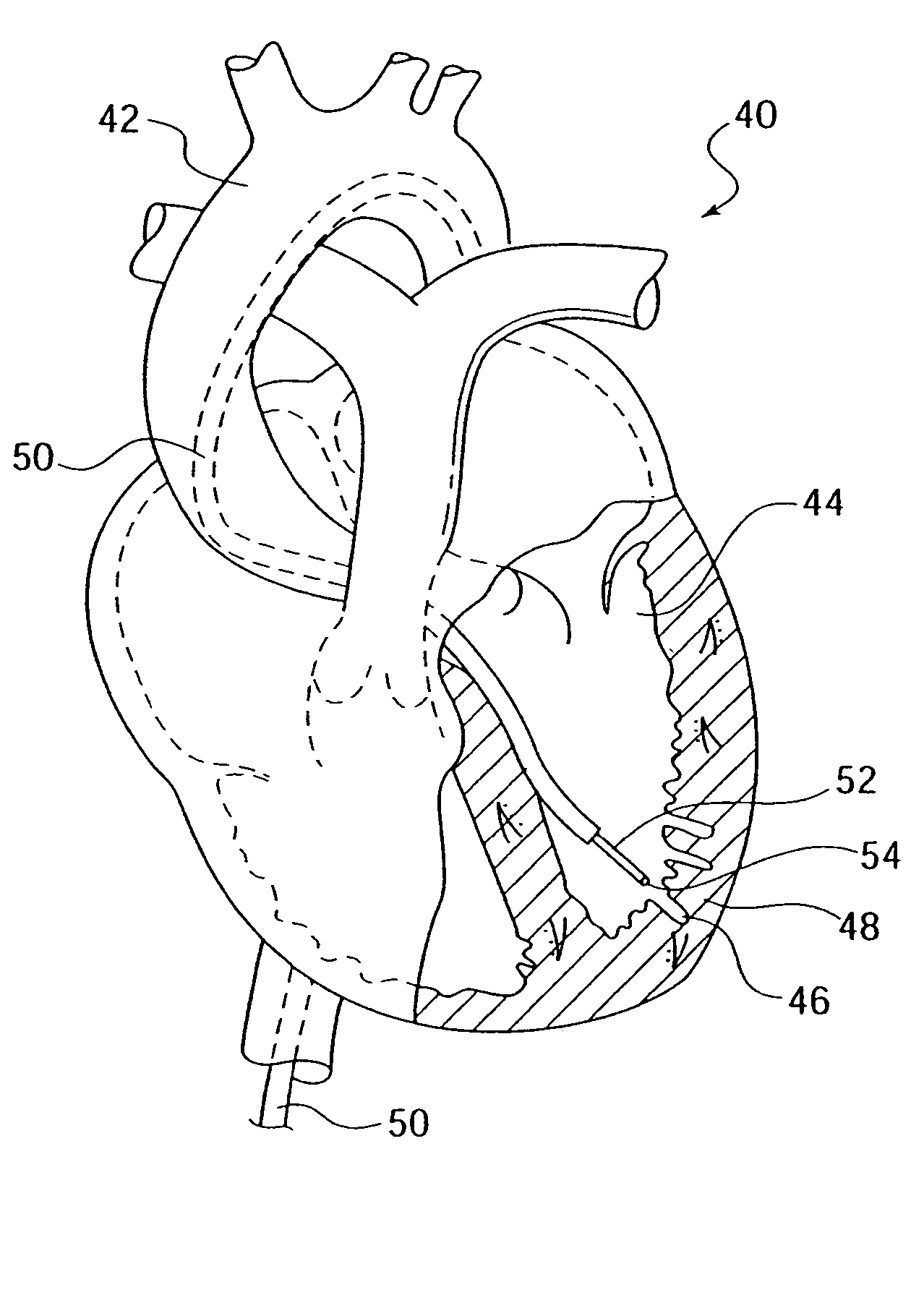 Elongated medical device with functional distal end