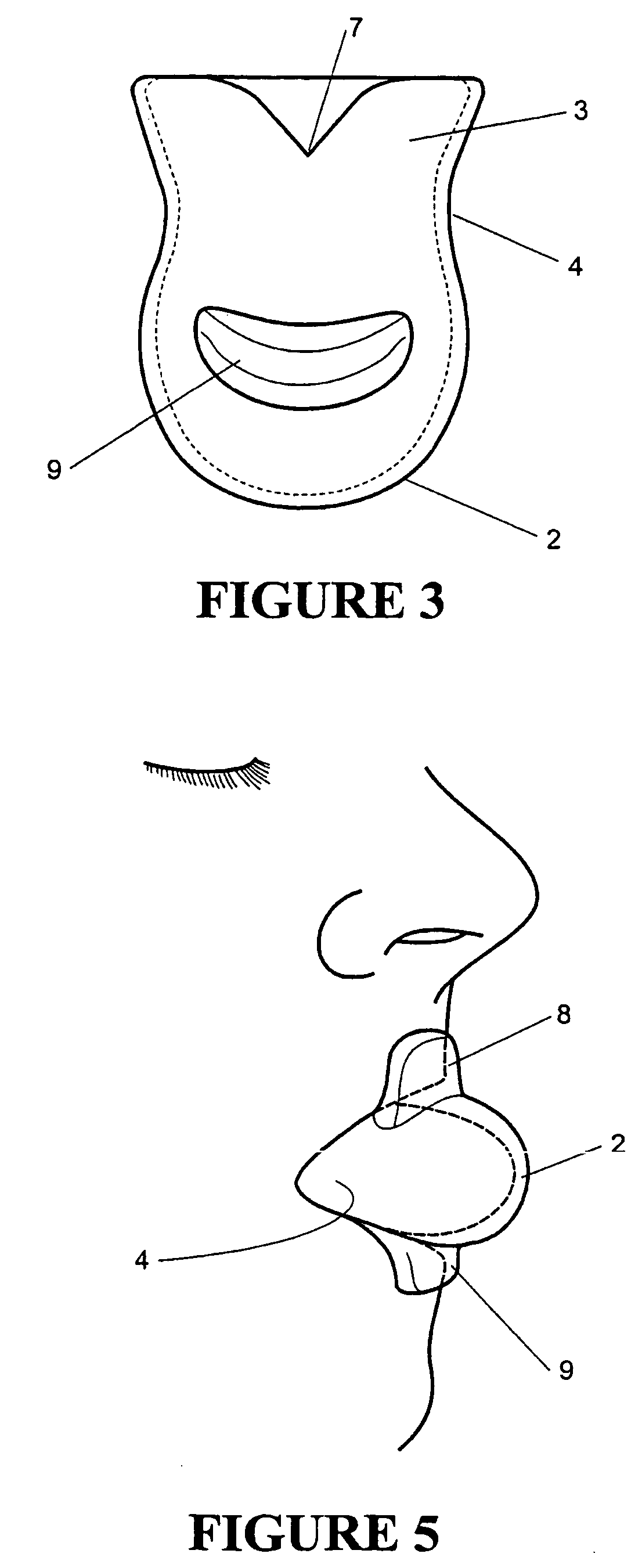 Tongue stabilizing device