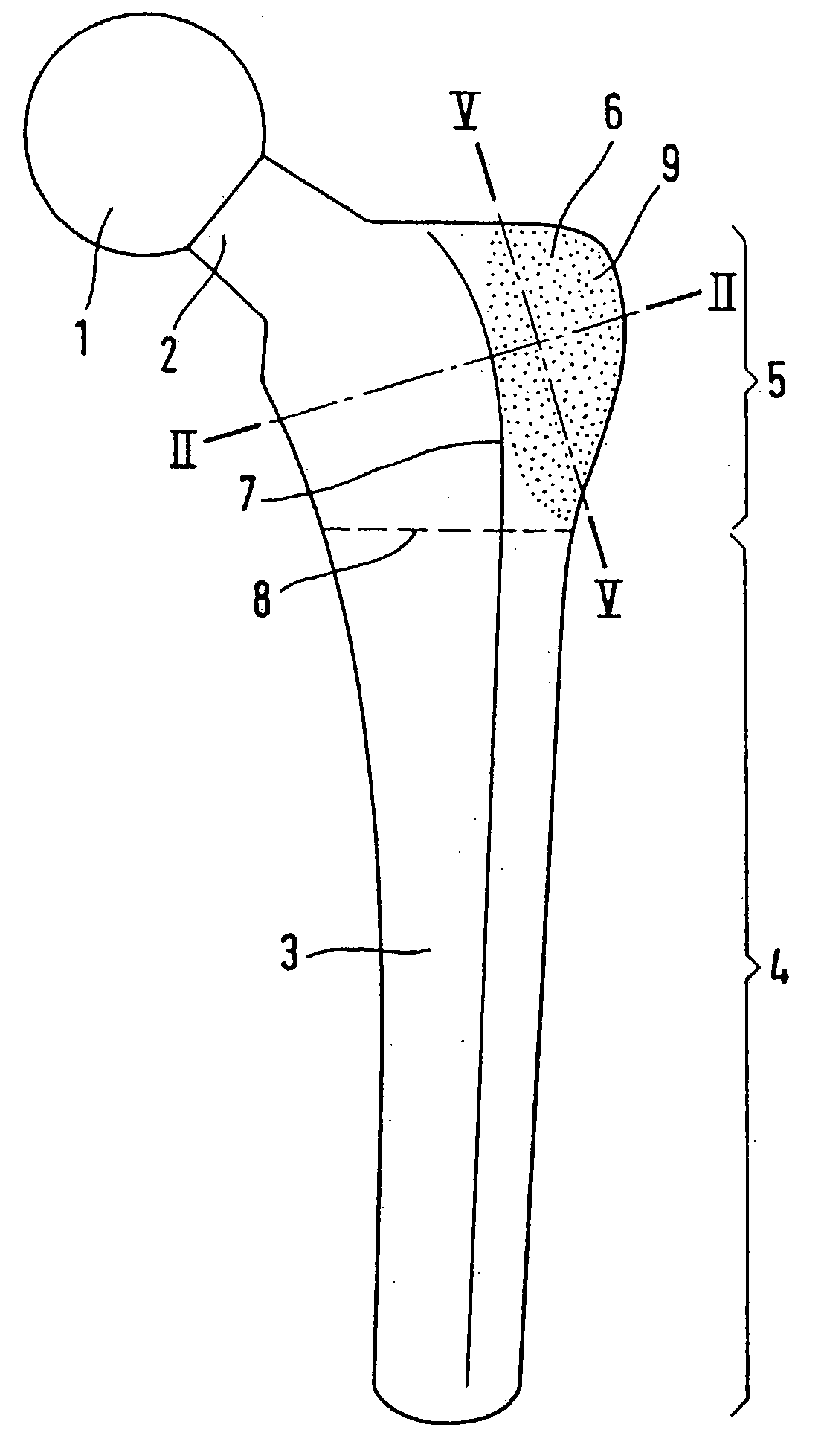 Hip Joint Prosthesis with a Shaft to be Inserted Into the Femur