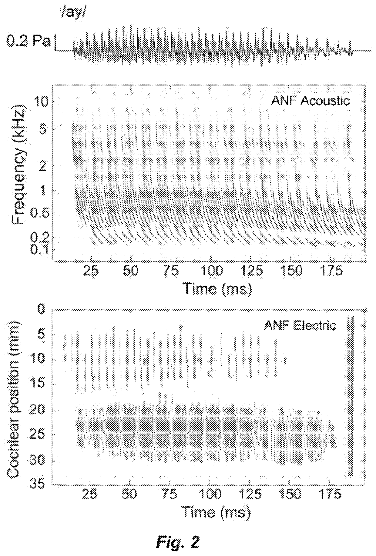 Fast objective fitting measurements for cochlear implants