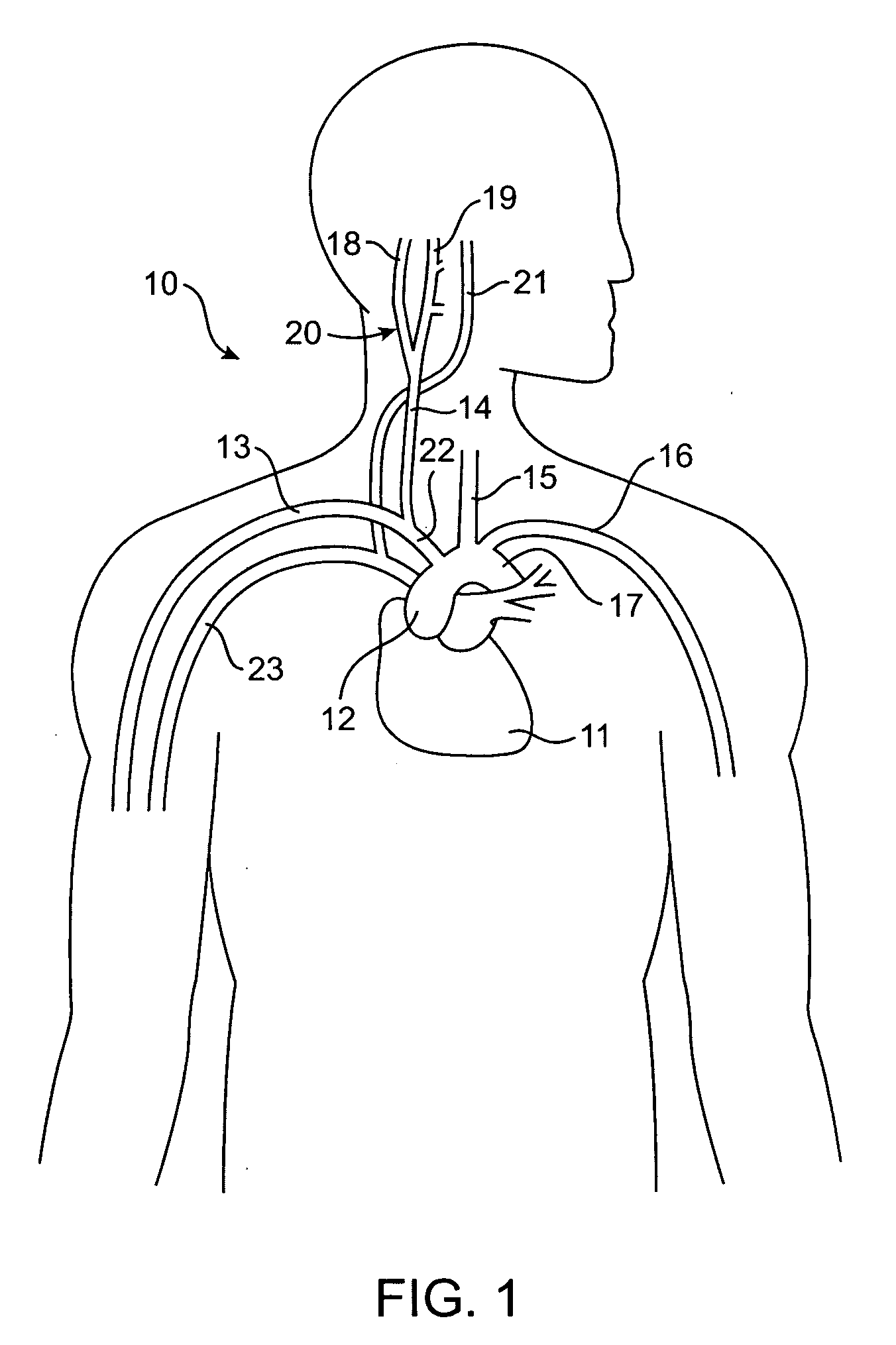 Baroreflex activation therapy with conditional shut off