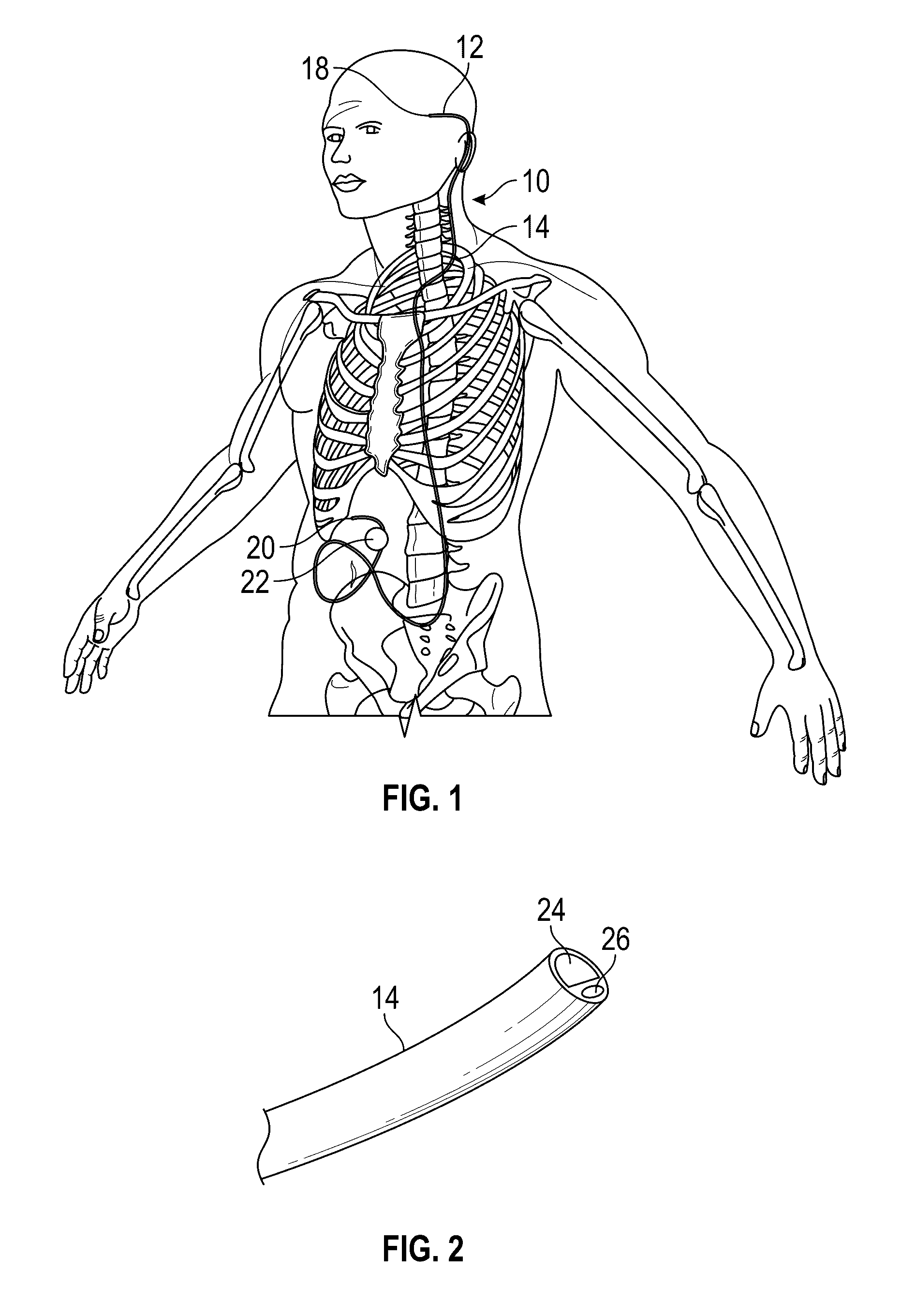 Ventriculoperitoneal shunt with distal balloon