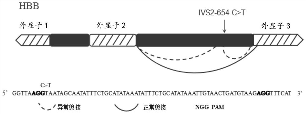 SgRNA and use thereof in repairing abnormal splicing of introns