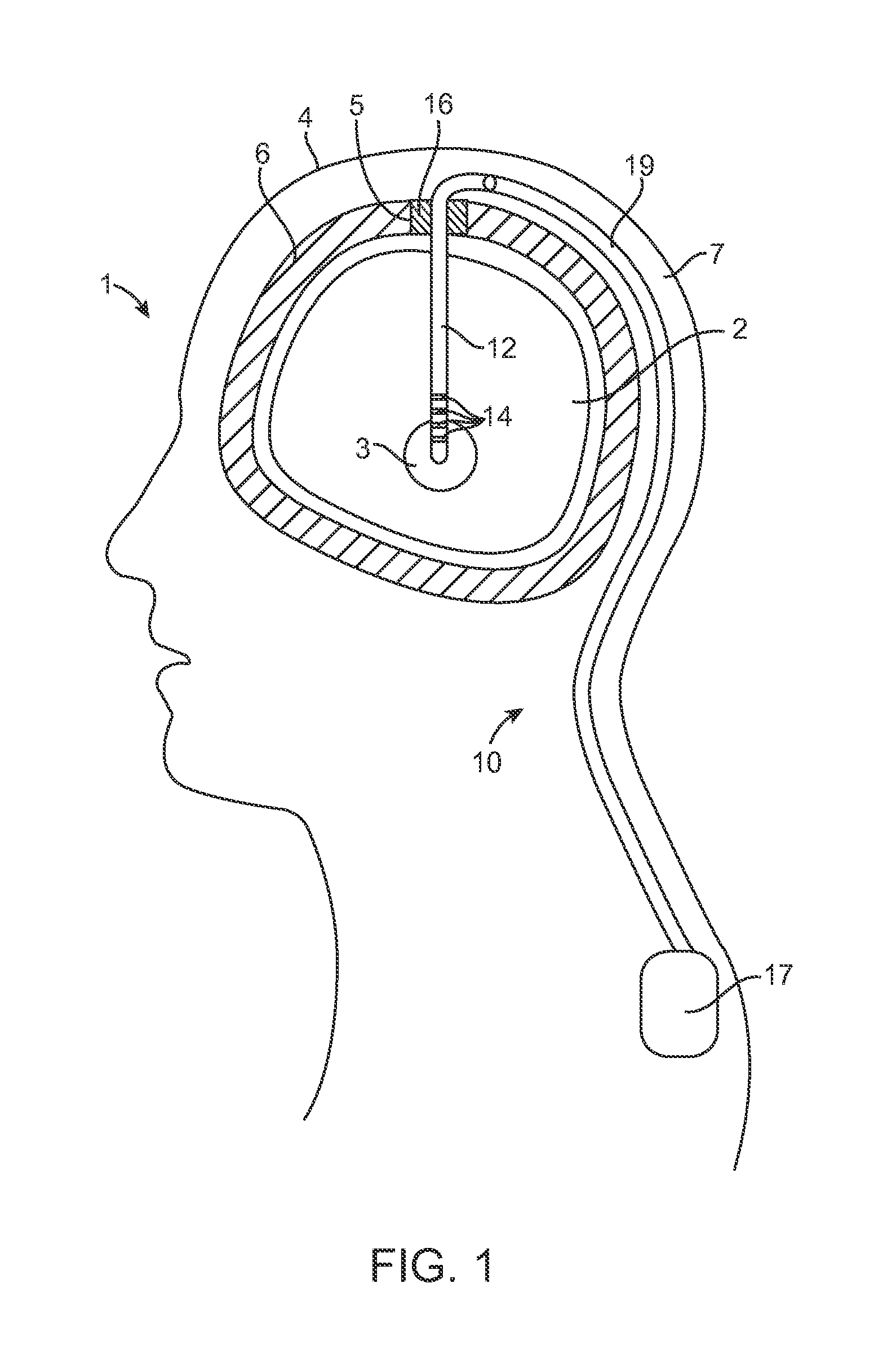 Cranial burr hole plug with Anti-skewing clamping mechanism