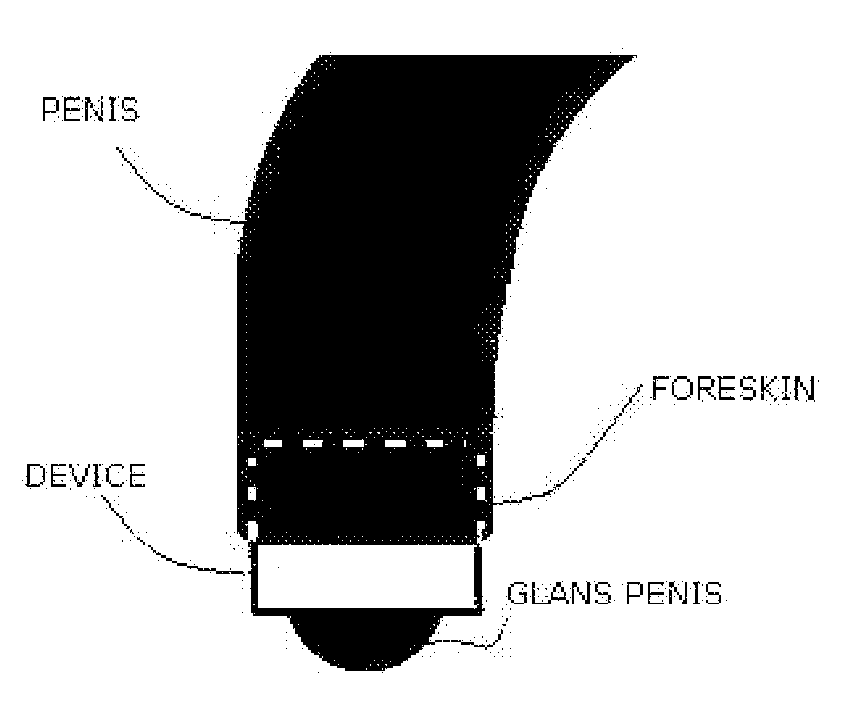 Device for prophylactics and treatment of balanitis