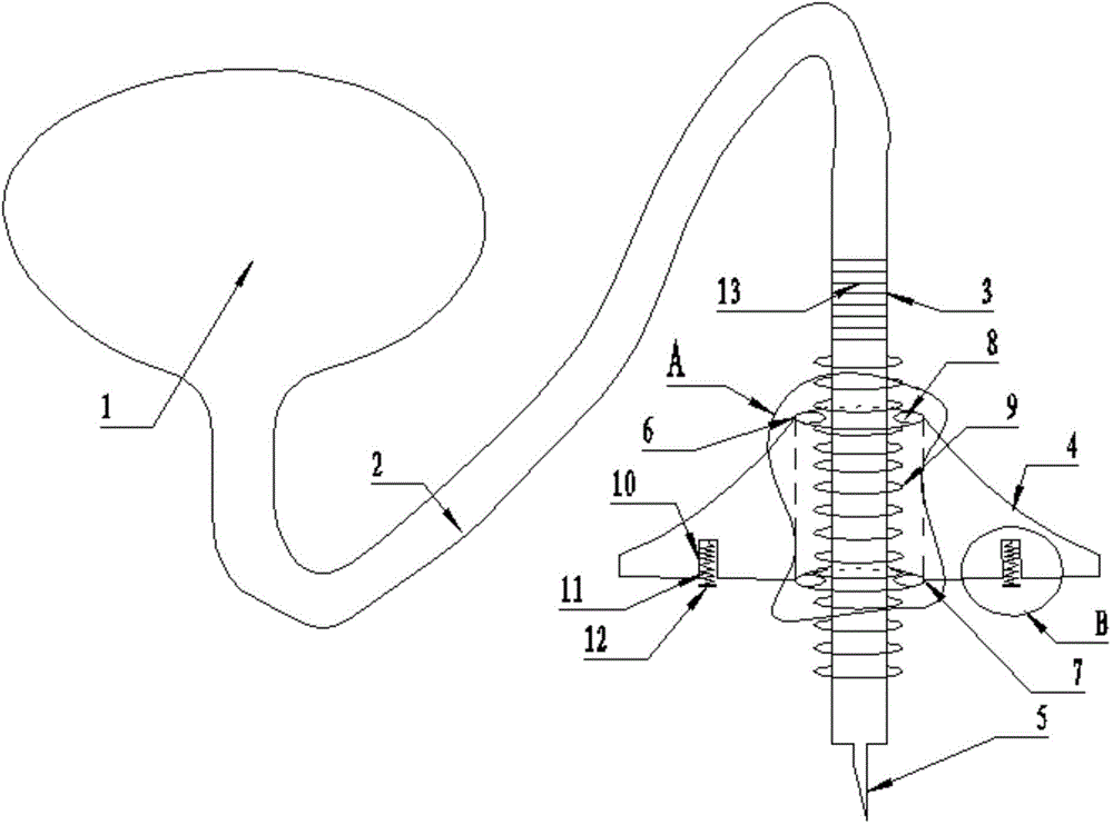 Rapidly-withdrawn anesthetic needle