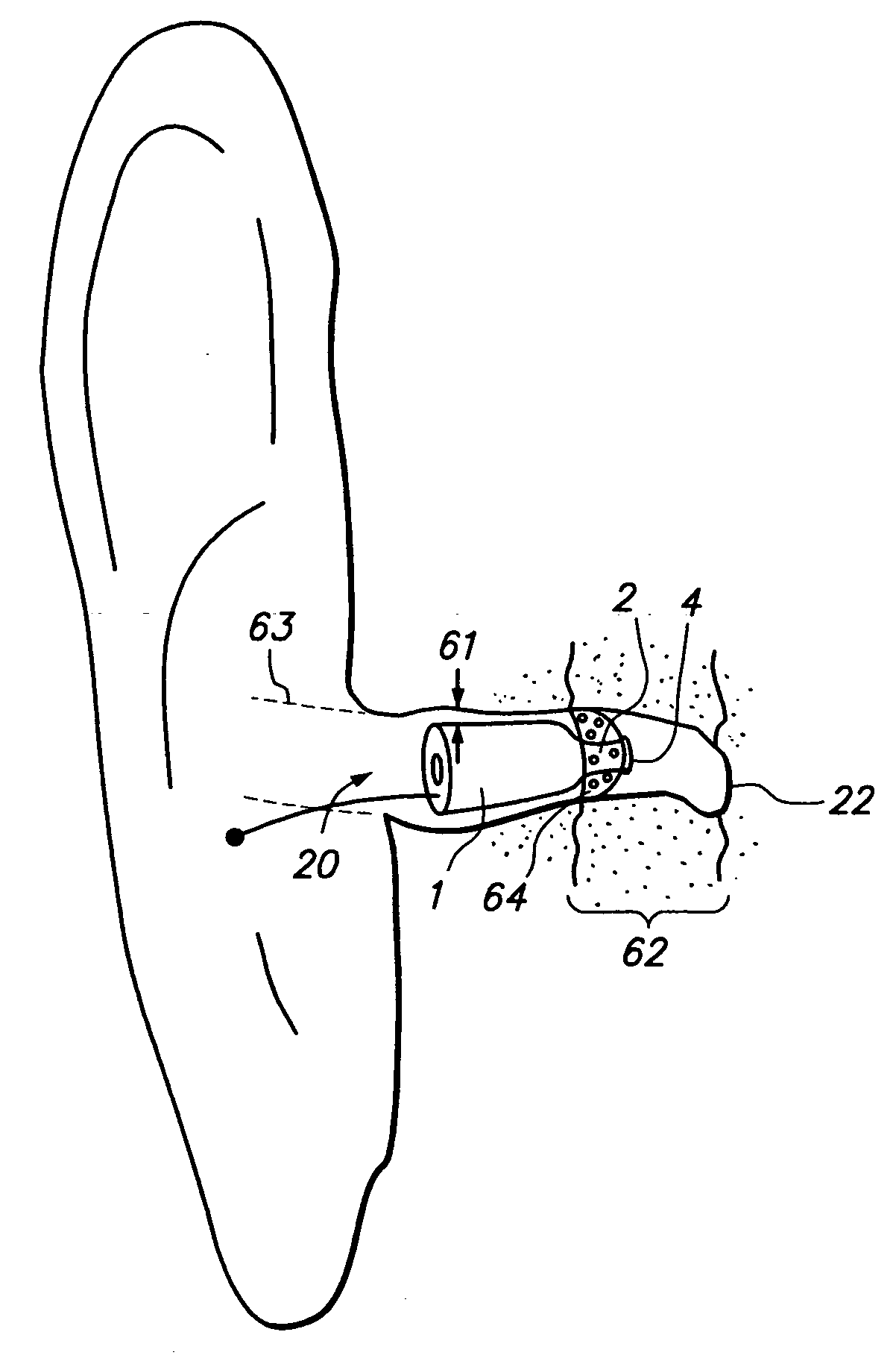 Open fit canal hearing device
