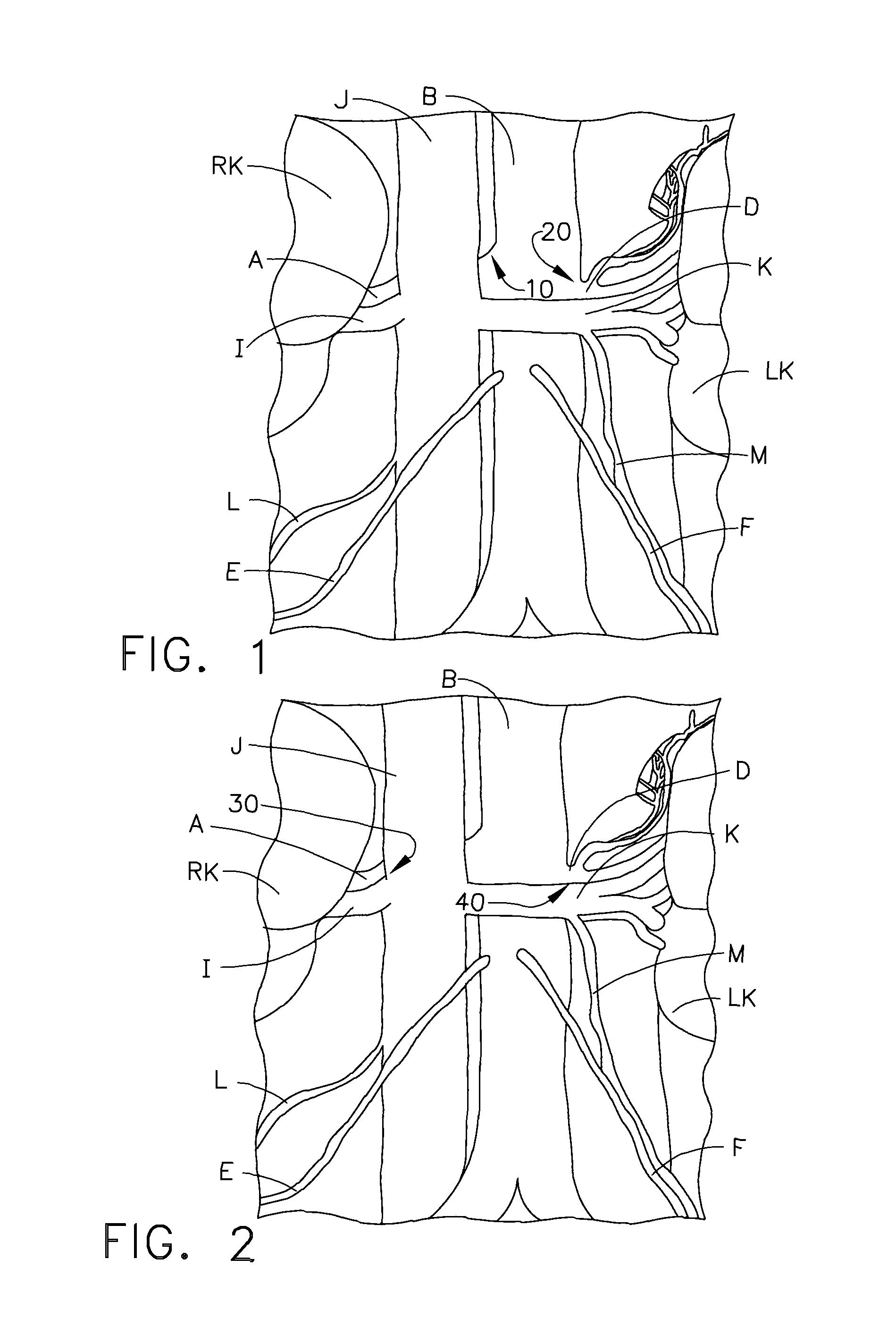 Ablation targeting nerves in or near the inferior vena cava and/or abdominal aorta for treatment of hypertension