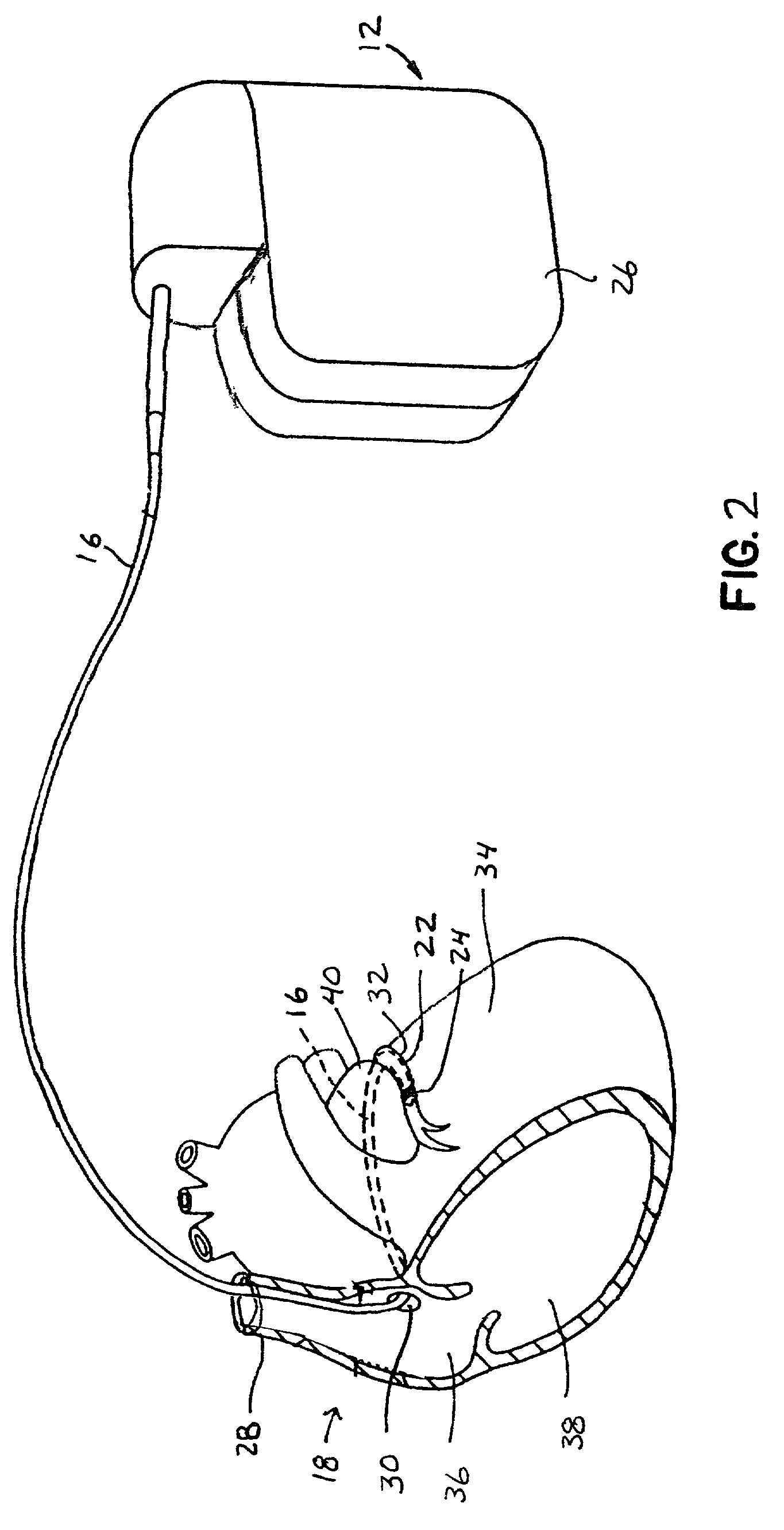 Method and apparatus for shielding coating for MRI resistant electrode systems