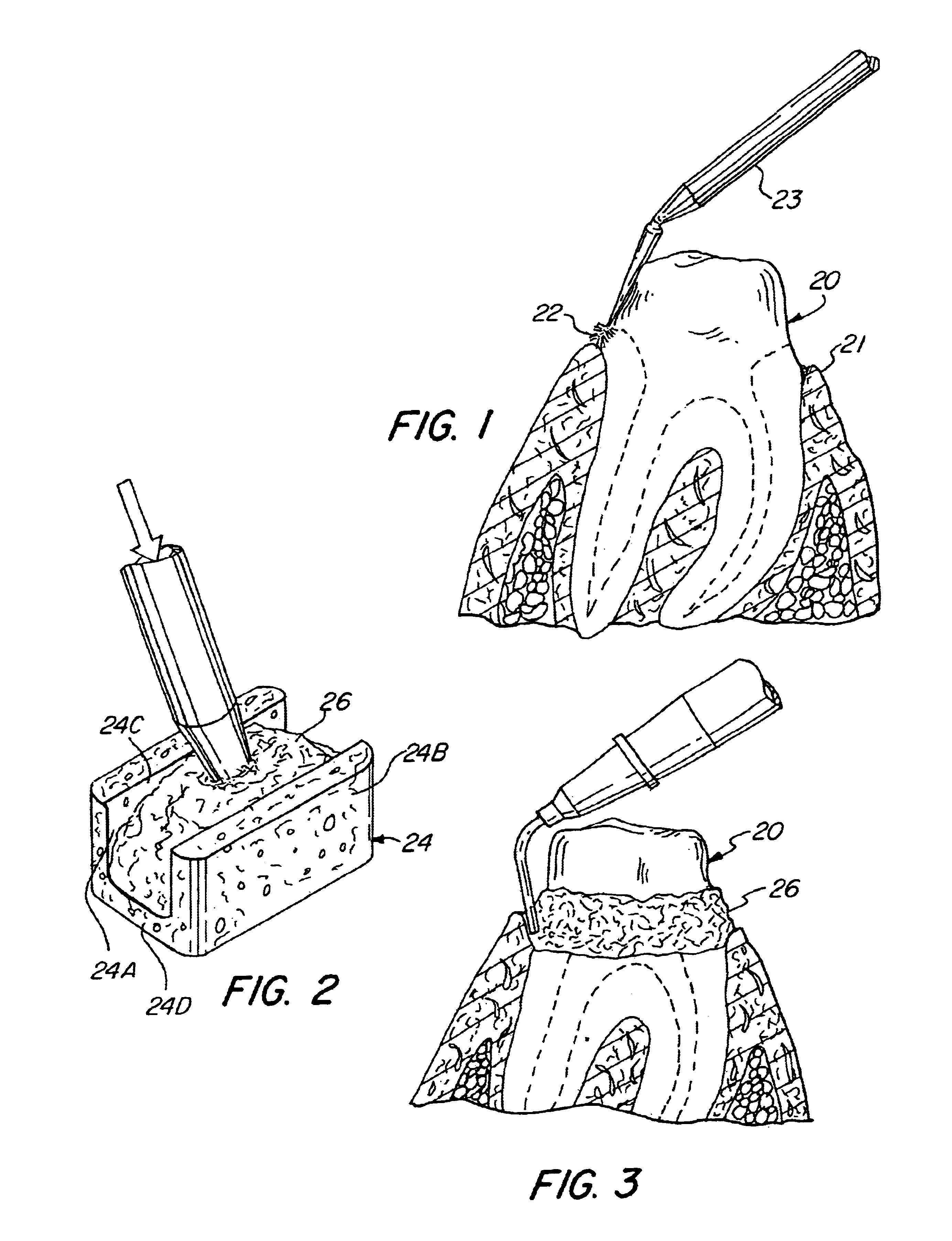 Method and device for the retraction and hemostasis of tissue during crown and bridge procedures