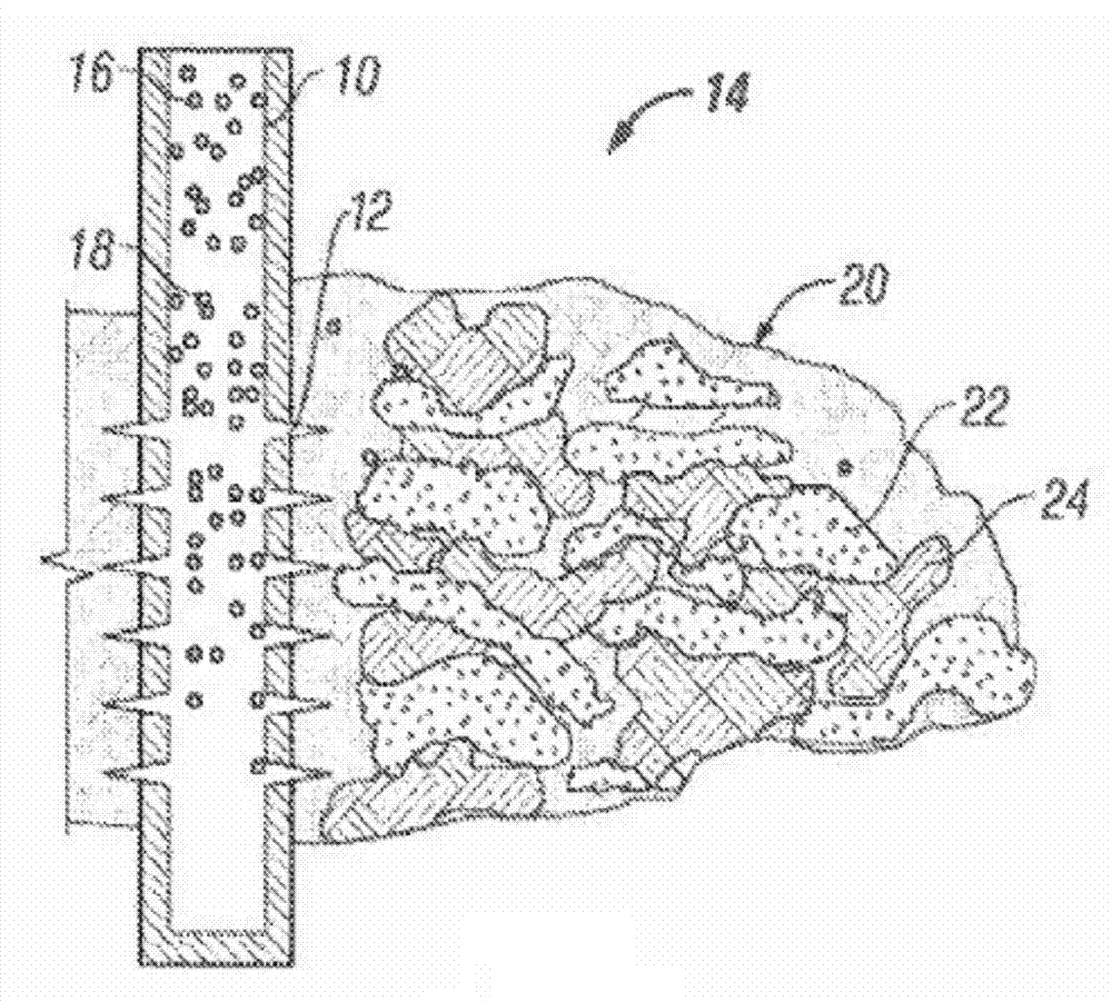 Heterogeneous proppant placement in a fracture with removable extrametrical material fill