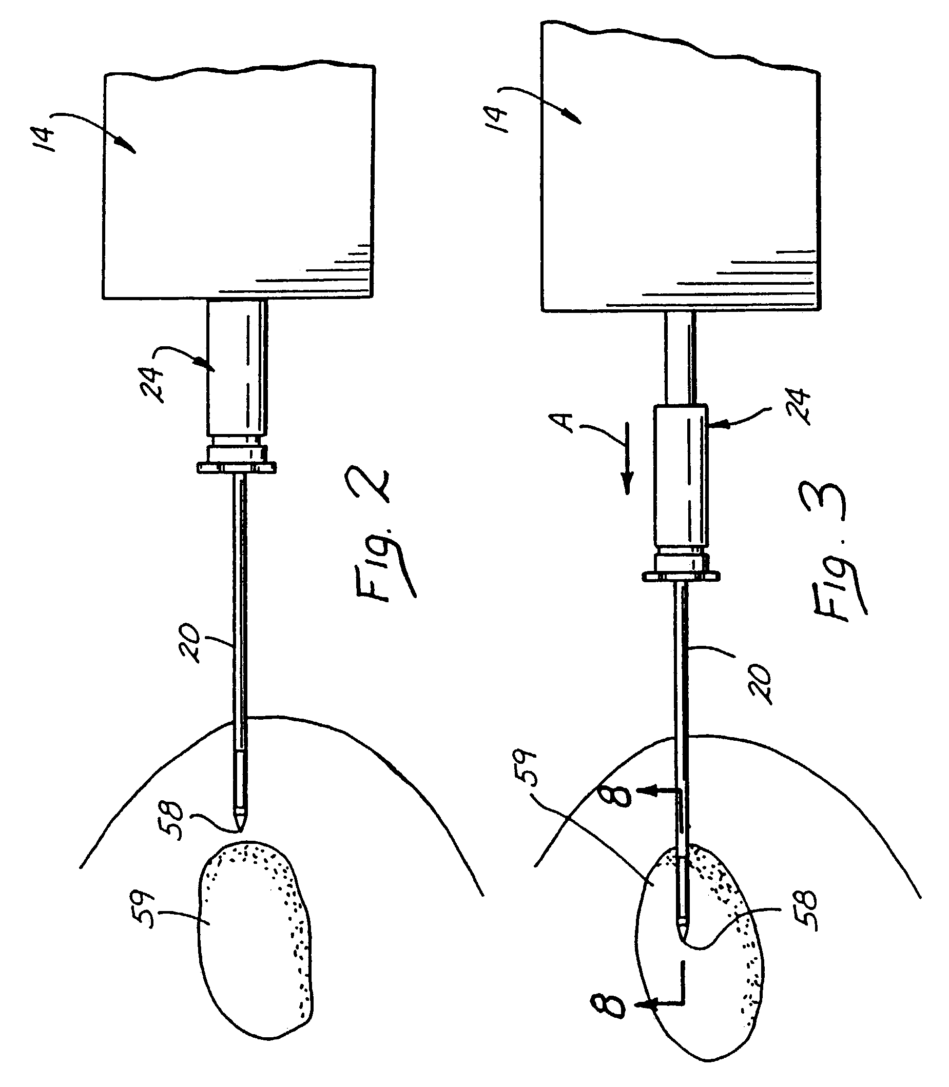Methods and devices for automated biopsy and collection of soft tissue