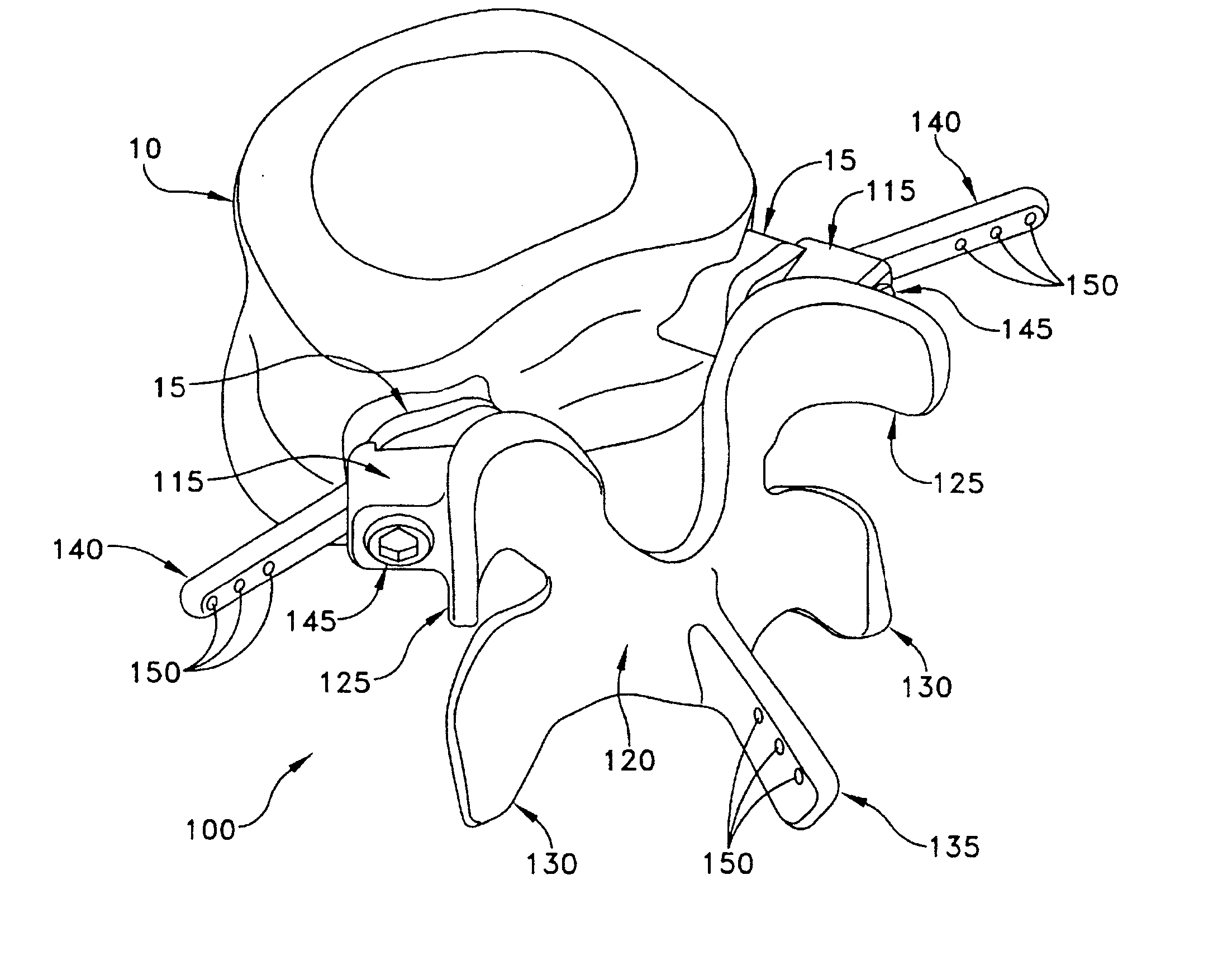 Prosthesis for the replacement of a posterior element of a vertebra