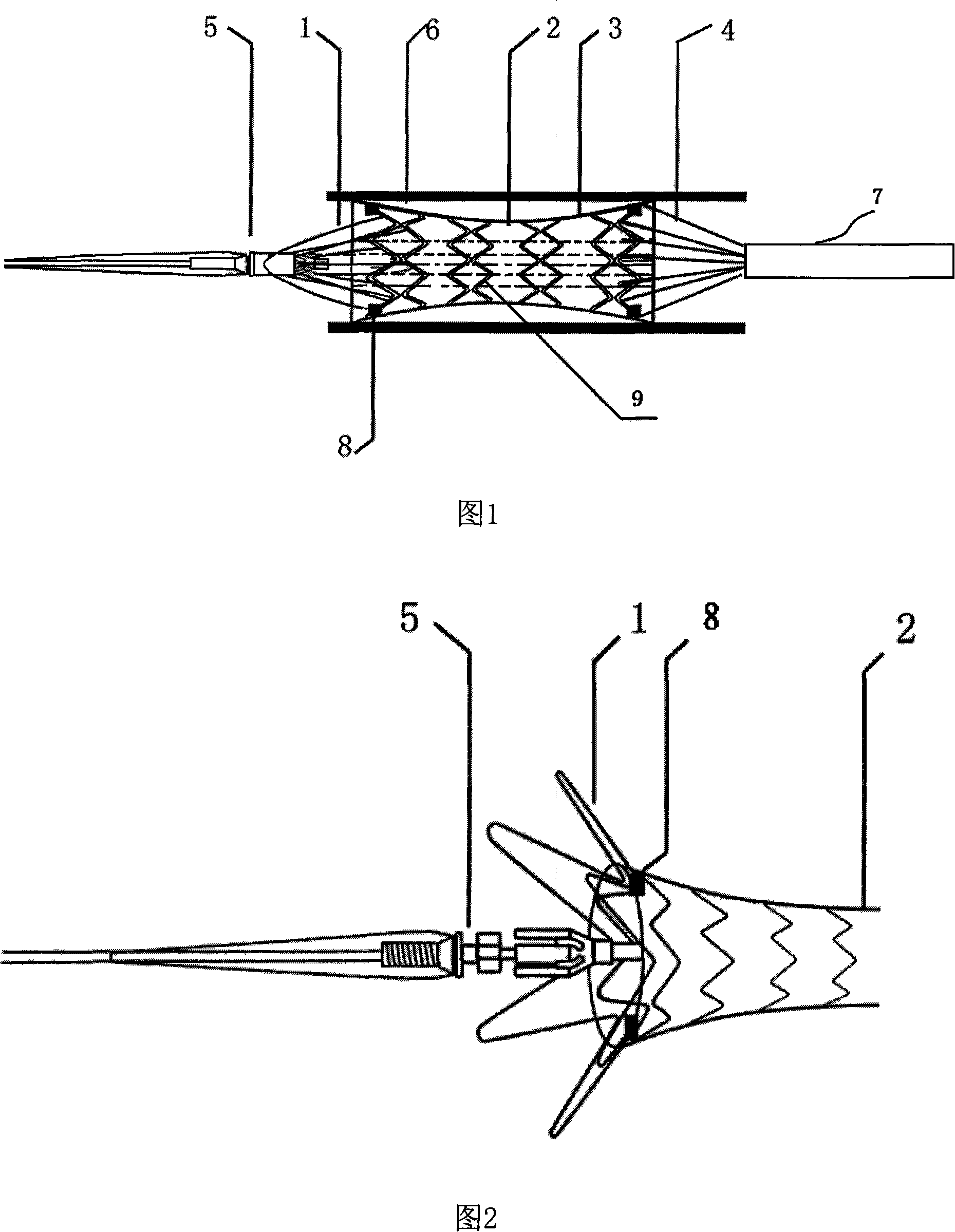 Pulmonary artery coarctation bracket for pulmonary hypertension surgery treat