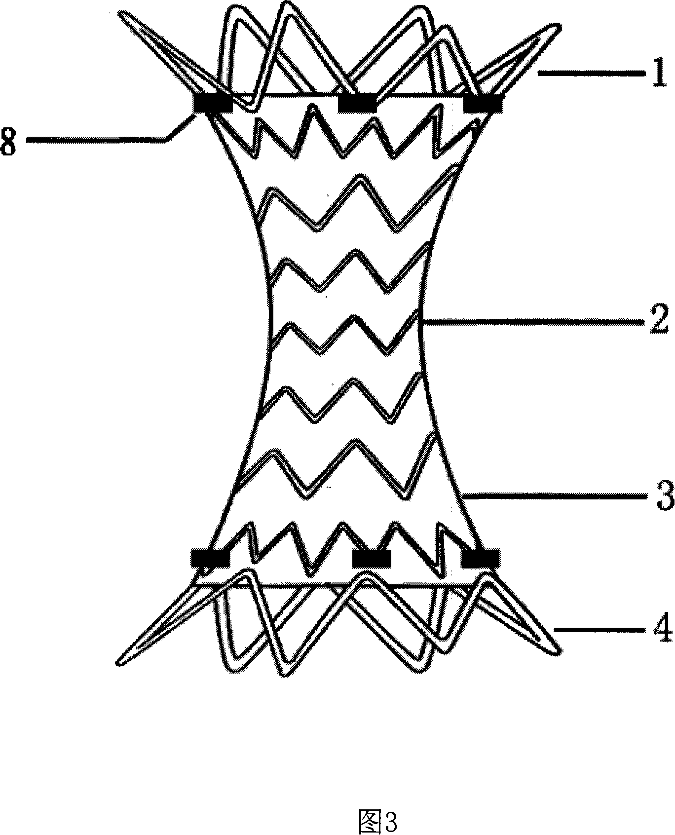 Pulmonary artery coarctation bracket for pulmonary hypertension surgery treat