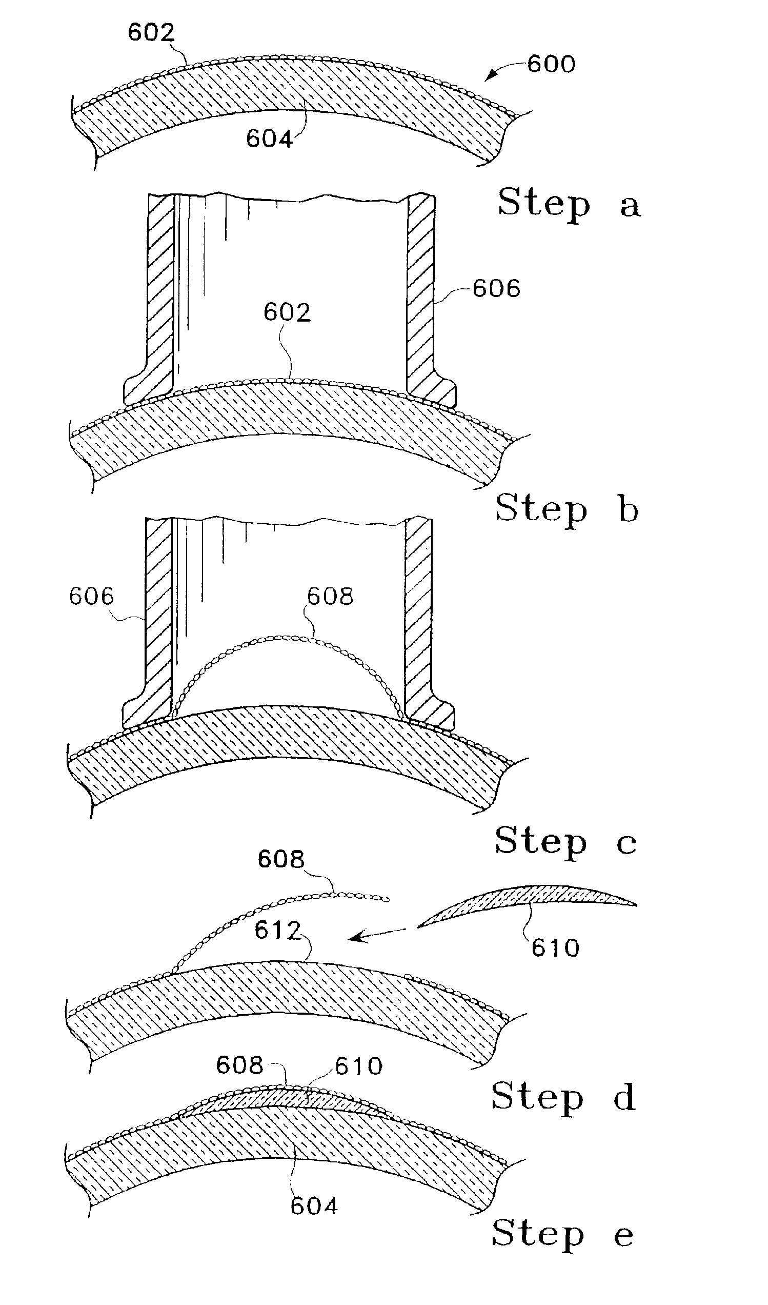 Method of lifting an epithelial layer and placing a corrective lens beneath it