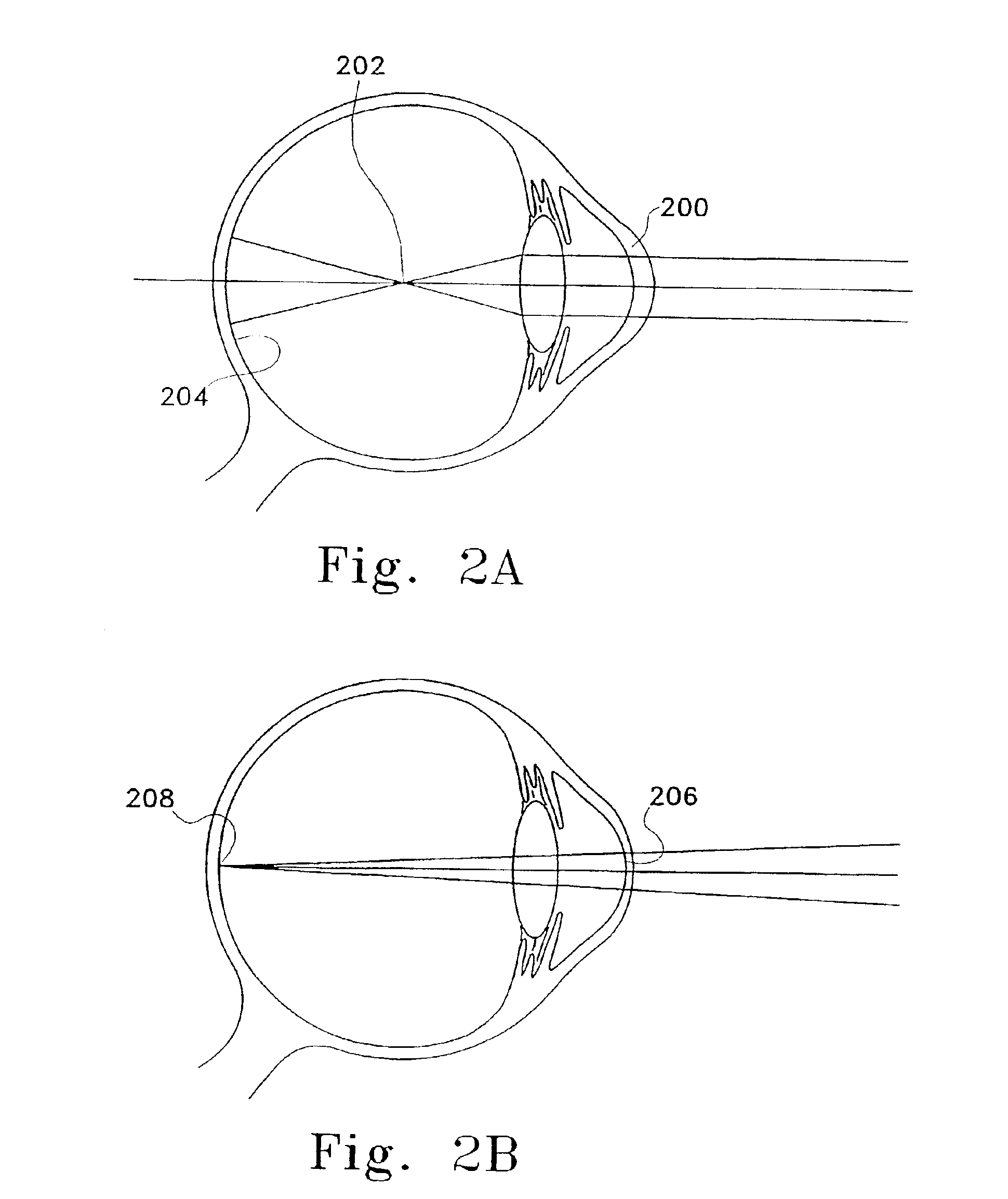 Method of lifting an epithelial layer and placing a corrective lens beneath it