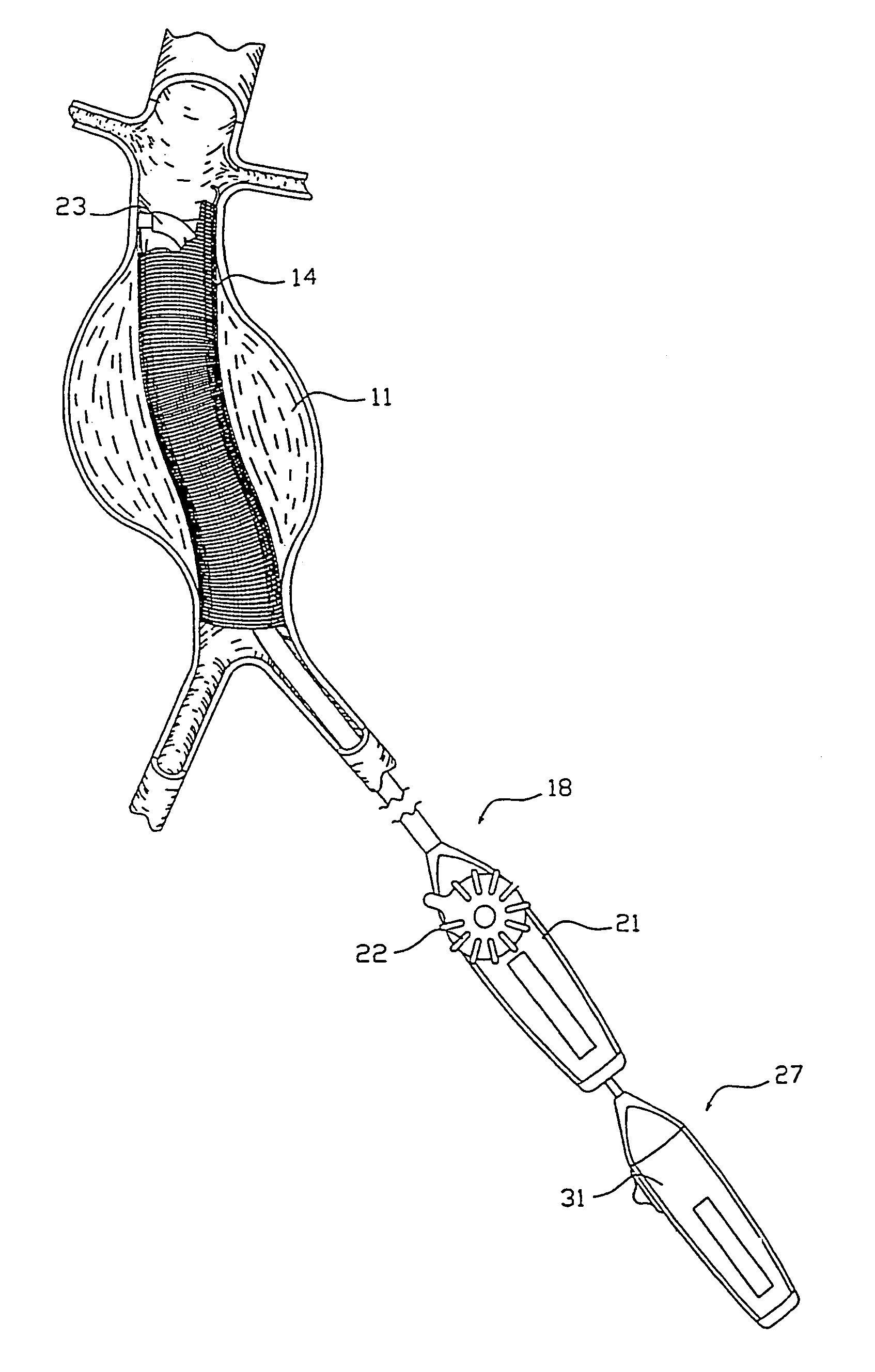 Intraluminal prosthesis attachment systems and methods