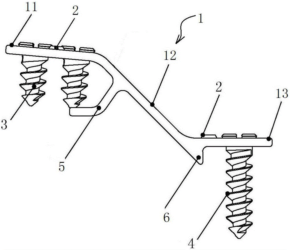 Spine vertebral plate bridging system