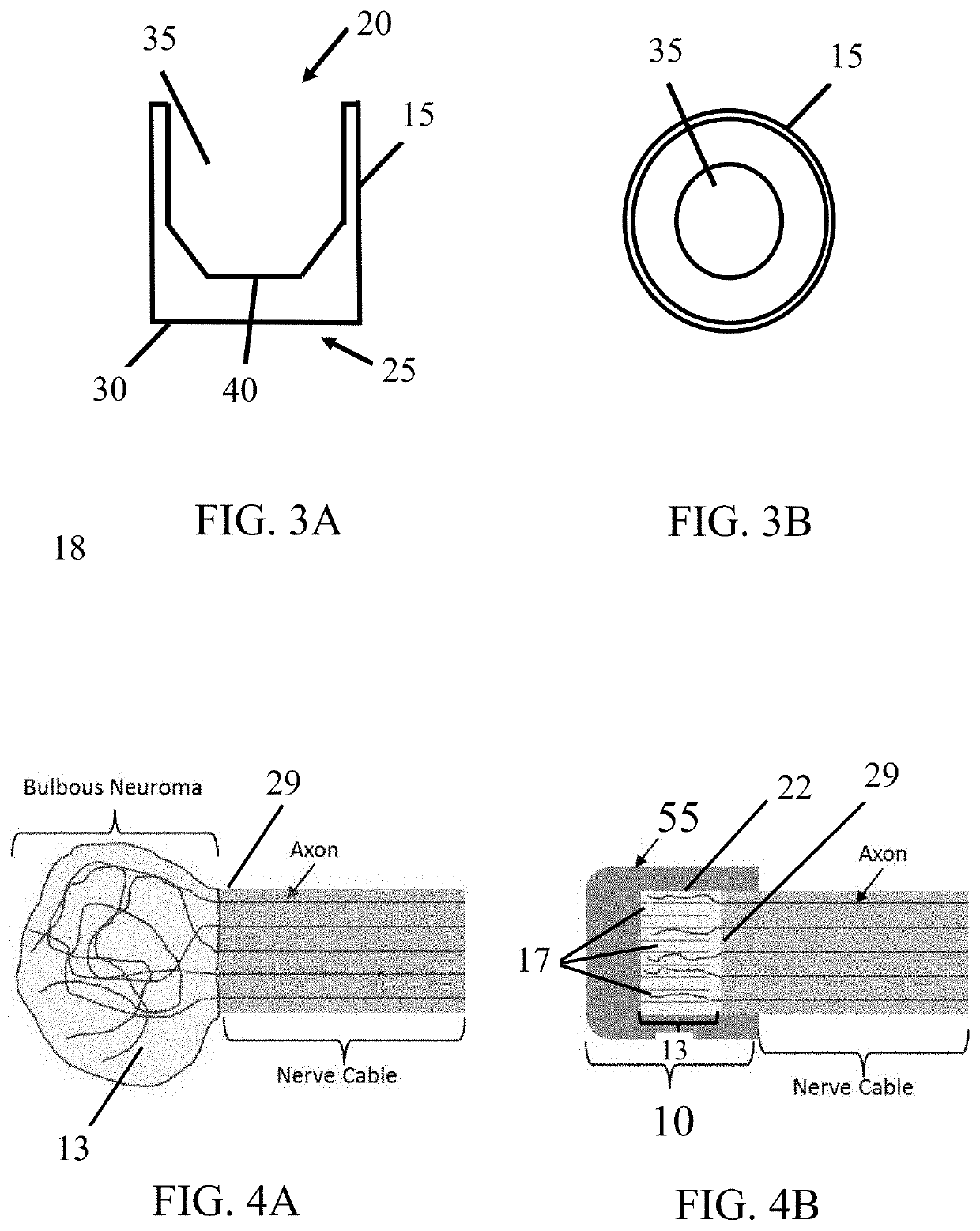 Materials and methods for protecting against neuromas