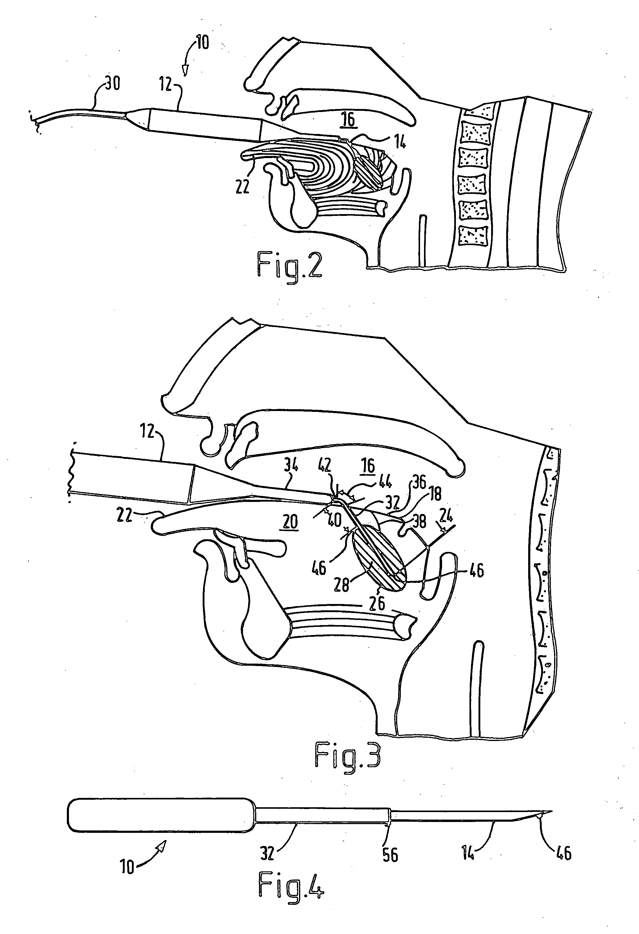 Electrosurgical method and apparatus