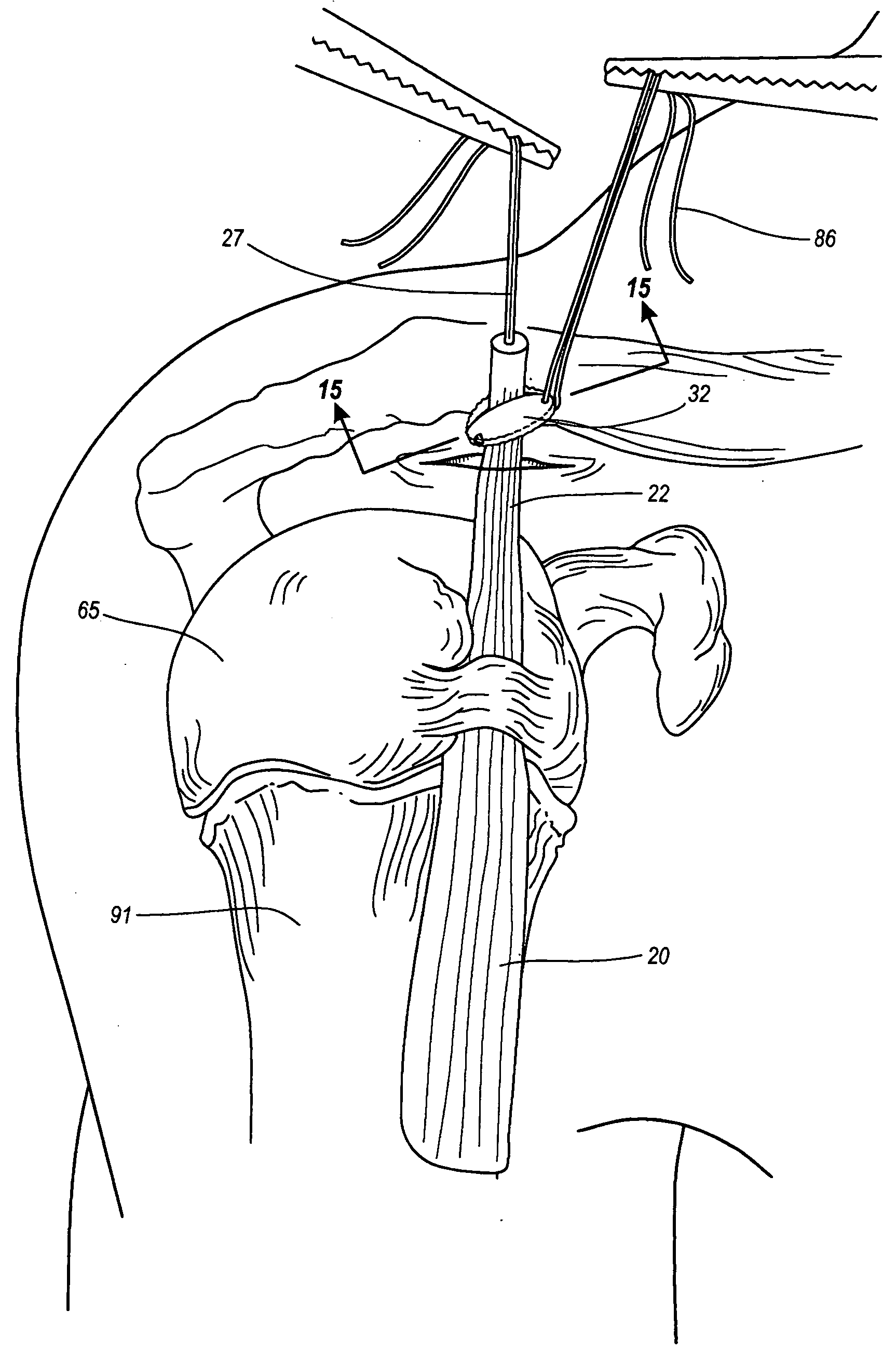 Method & apparatus for arthroscopic biceps tenodesis