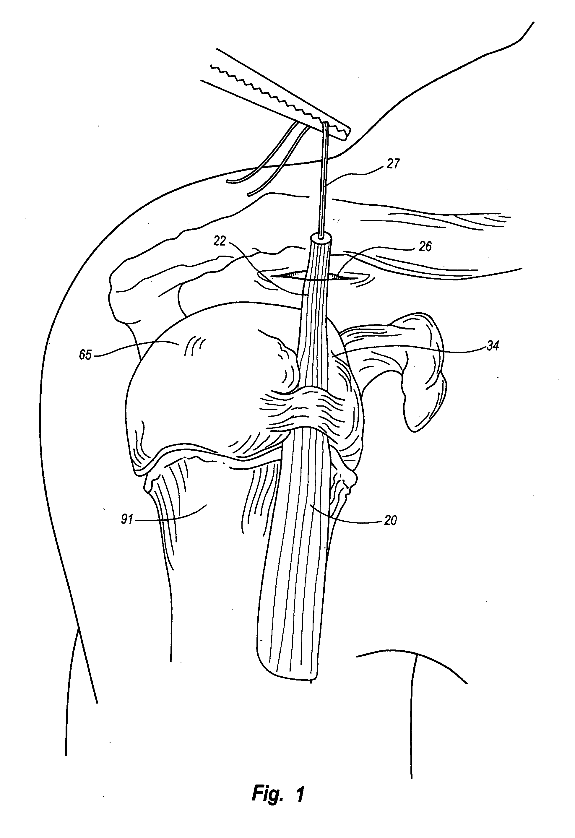 Method & apparatus for arthroscopic biceps tenodesis