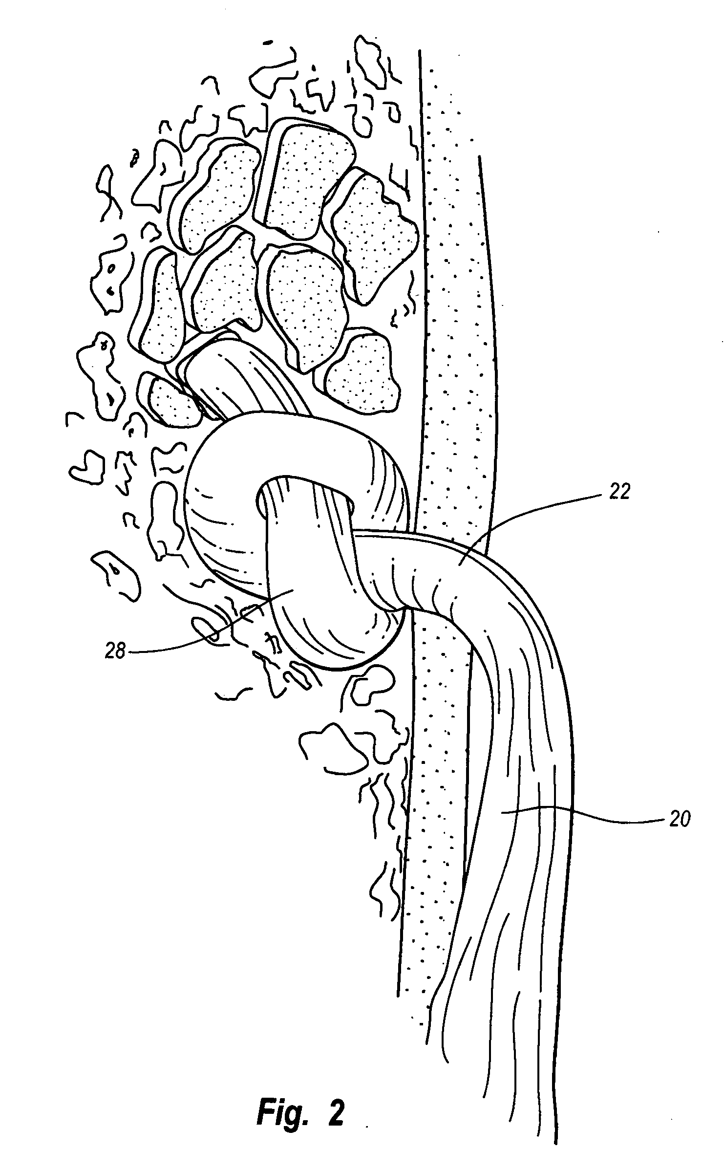 Method & apparatus for arthroscopic biceps tenodesis