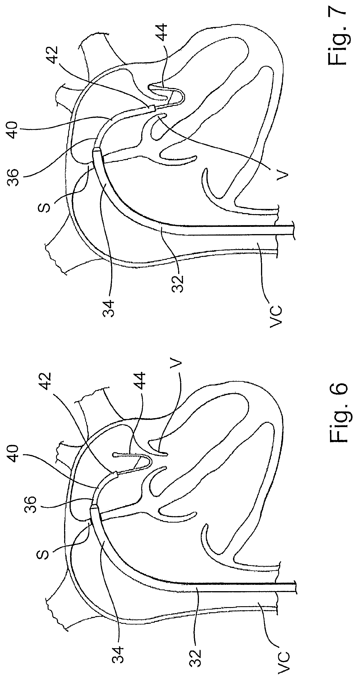 Device for arranging guidewires around a heart valve