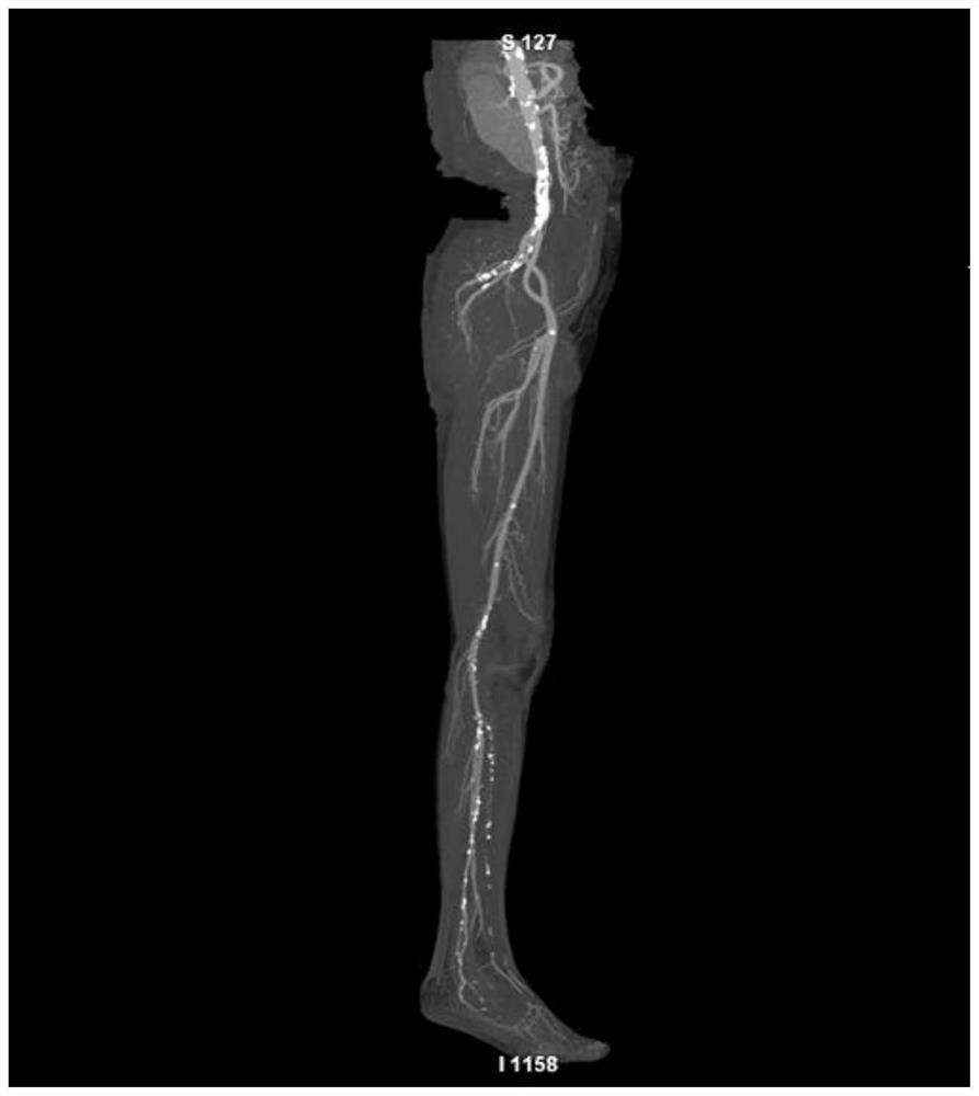 Clustering algorithm-based lower limb vascular calcification index multi-parameter accumulation calculation method