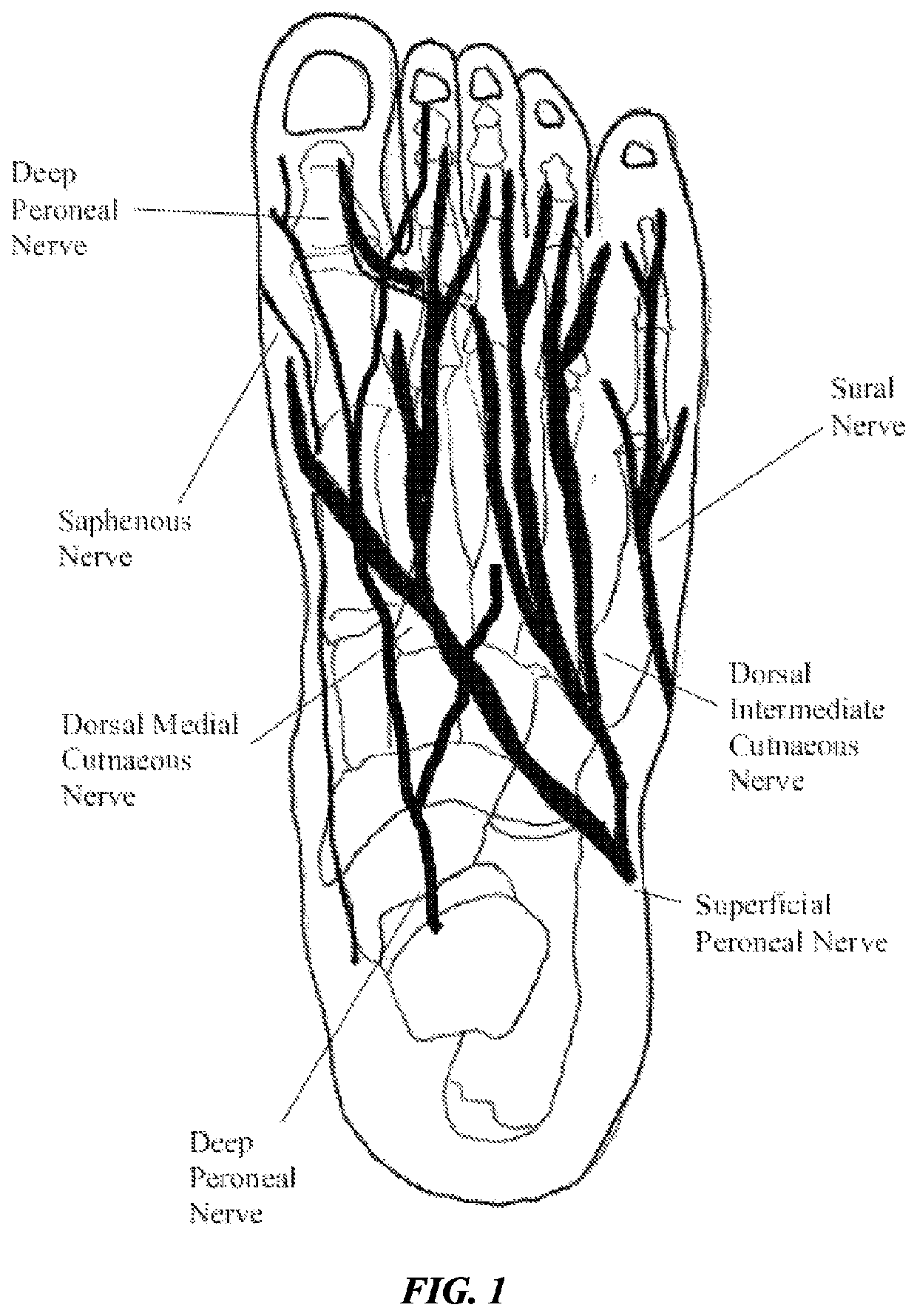 Peripheral neuromodulation to treat bladder and bowel dysfunction