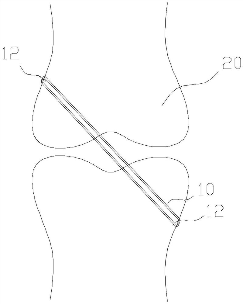 Artificial ligament and artificial ligament assembly